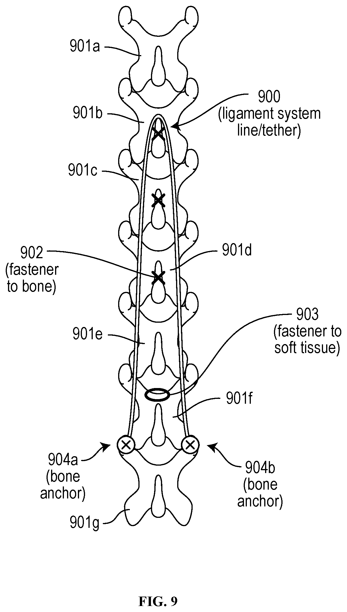 Patent US12310629 Figure 9 – Methods and devices for augmenting the spine