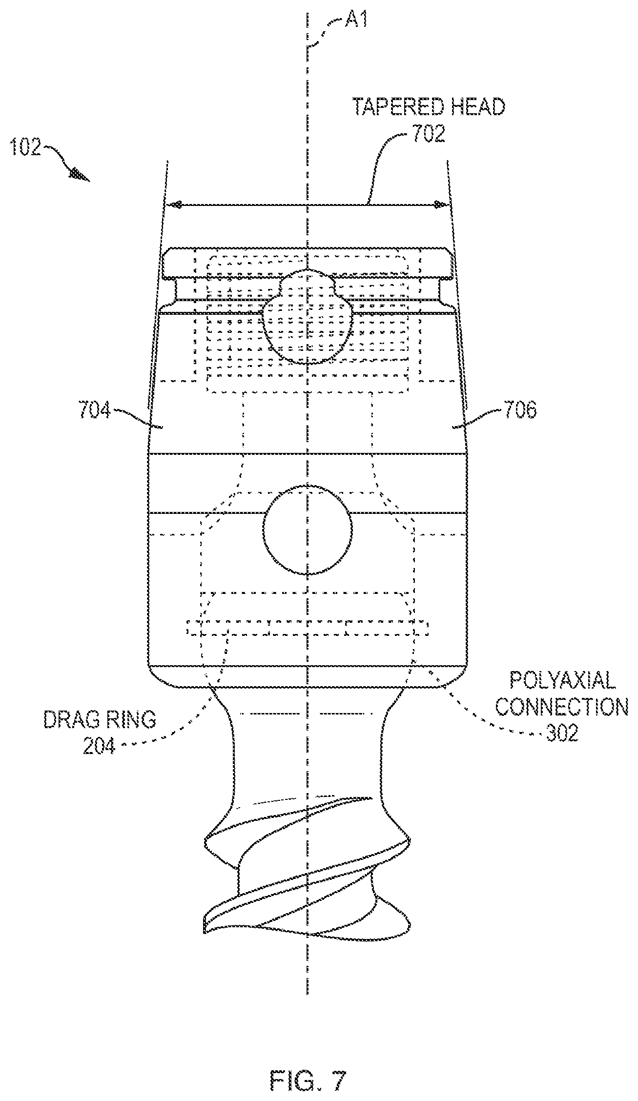 Patent US12310631 Figure 6 – Multi-feature polyaxial screw
