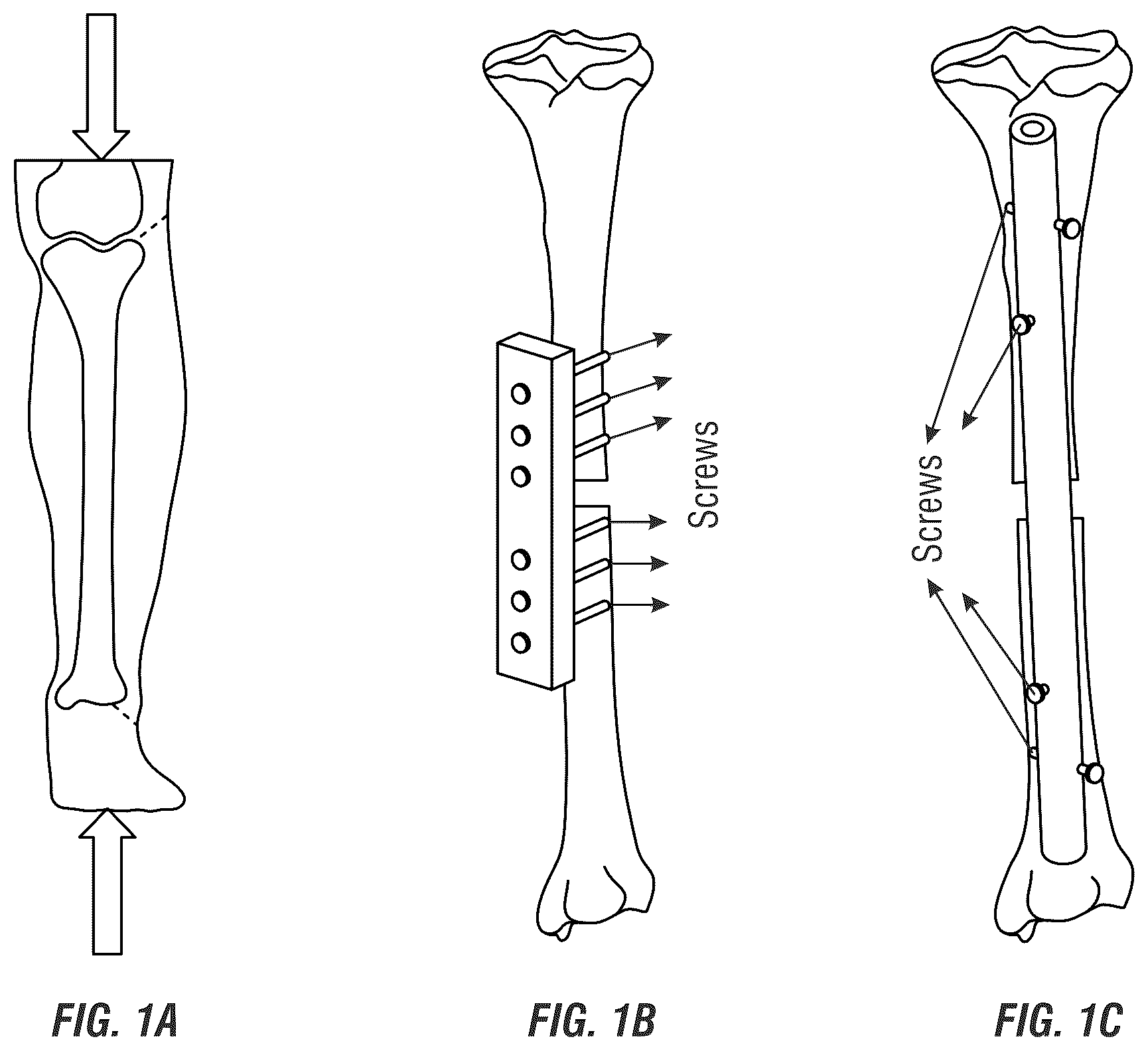 Patent US12310635 Figure 1 – Tunable stiffness bone rod