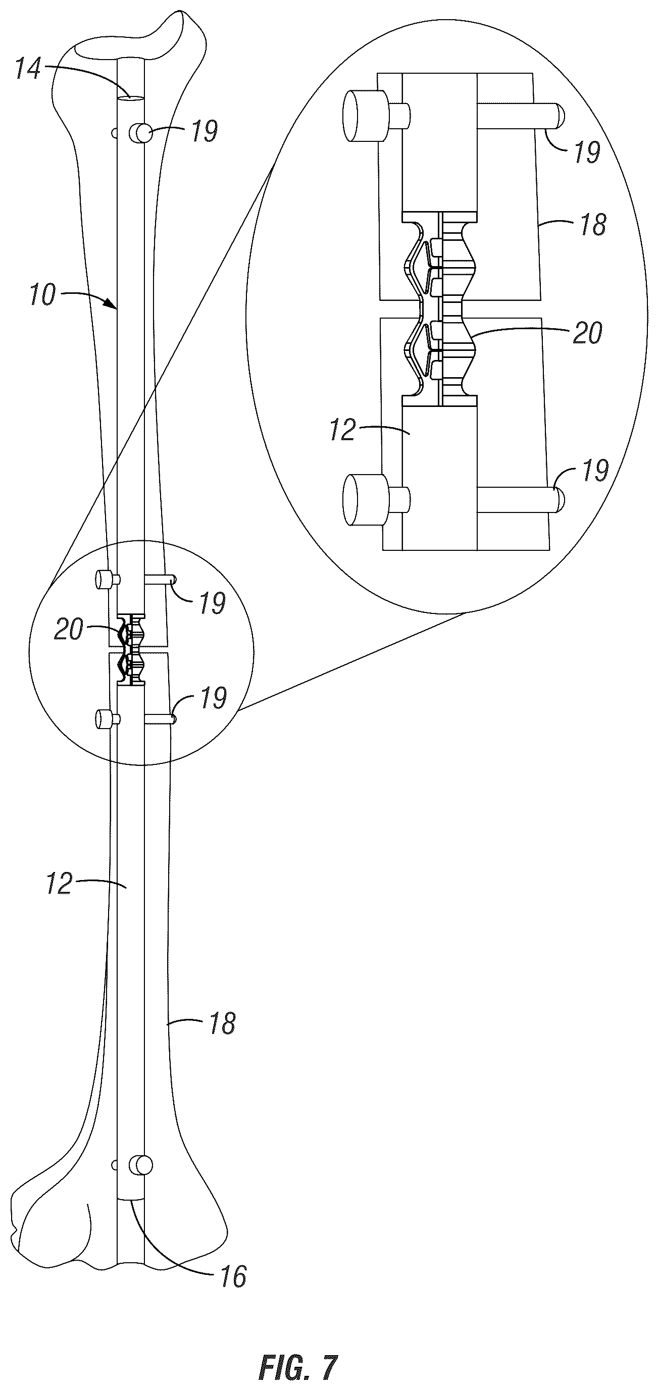 Patent US12310635 Figure 7 – Tunable stiffness bone rod