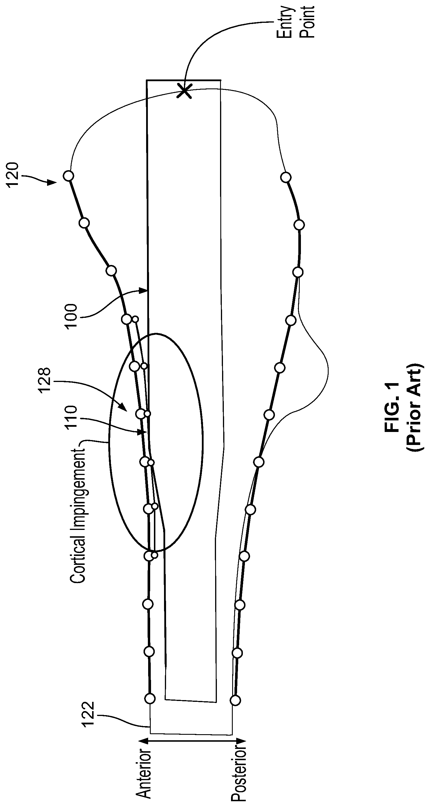 Patent US12310636 — Femoral nail with enhanced bone conforming geometry — Figure 1
