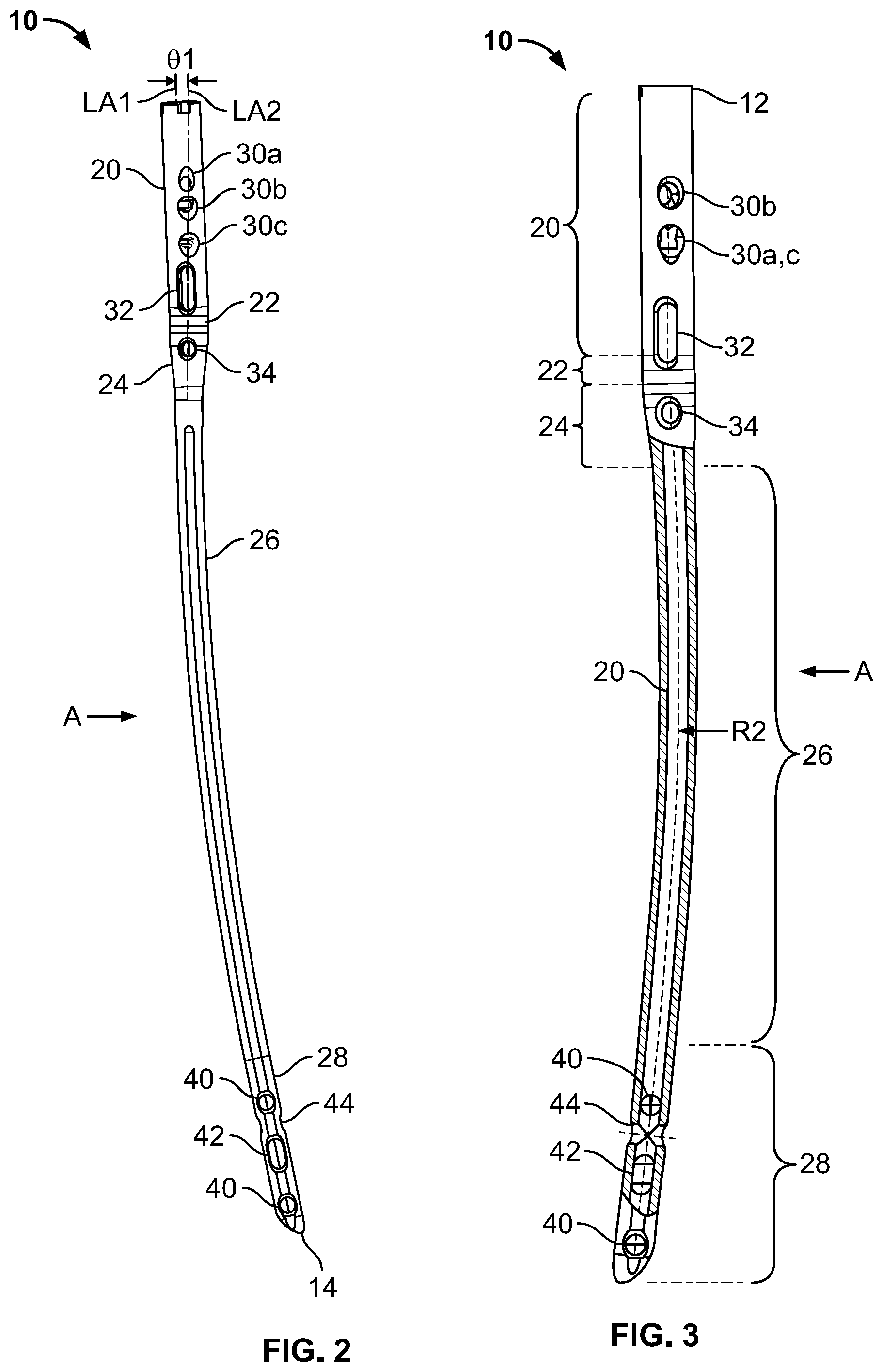Patent US12310636 Figure 2 – Femoral nail with enhanced bone conforming geometry