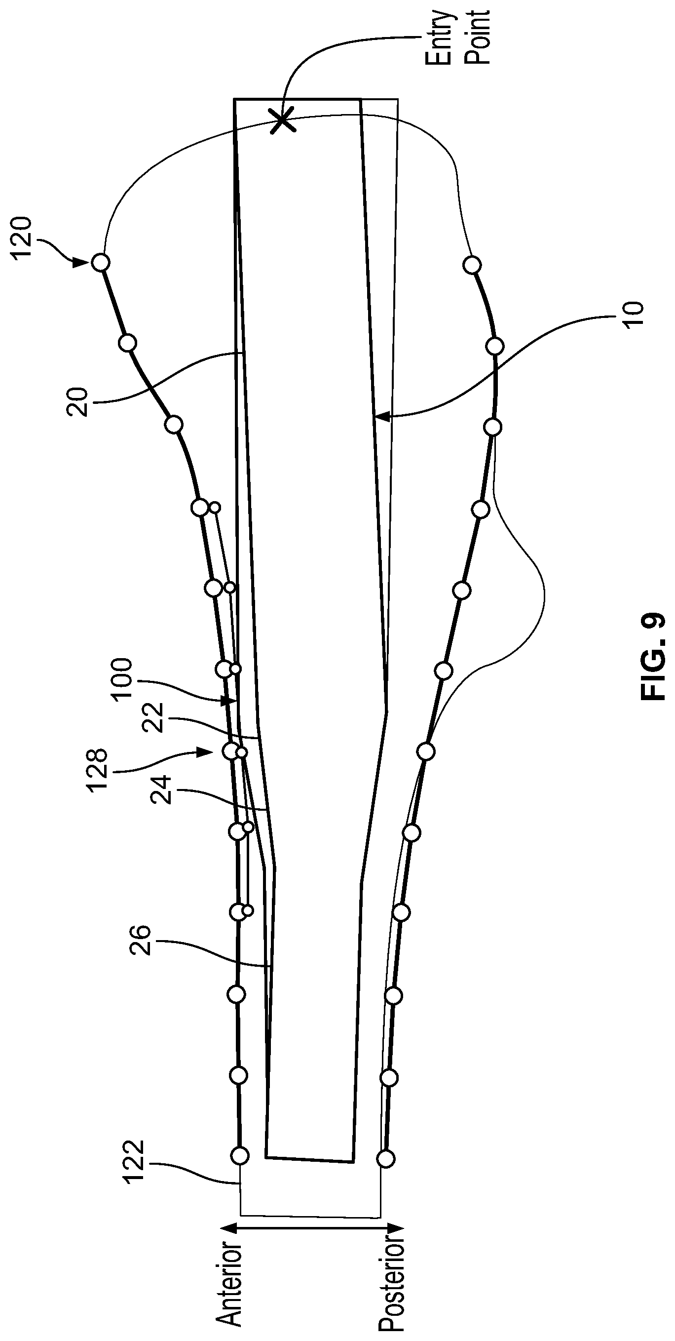 Patent US12310636 Figure 6 – Femoral nail with enhanced bone conforming geometry