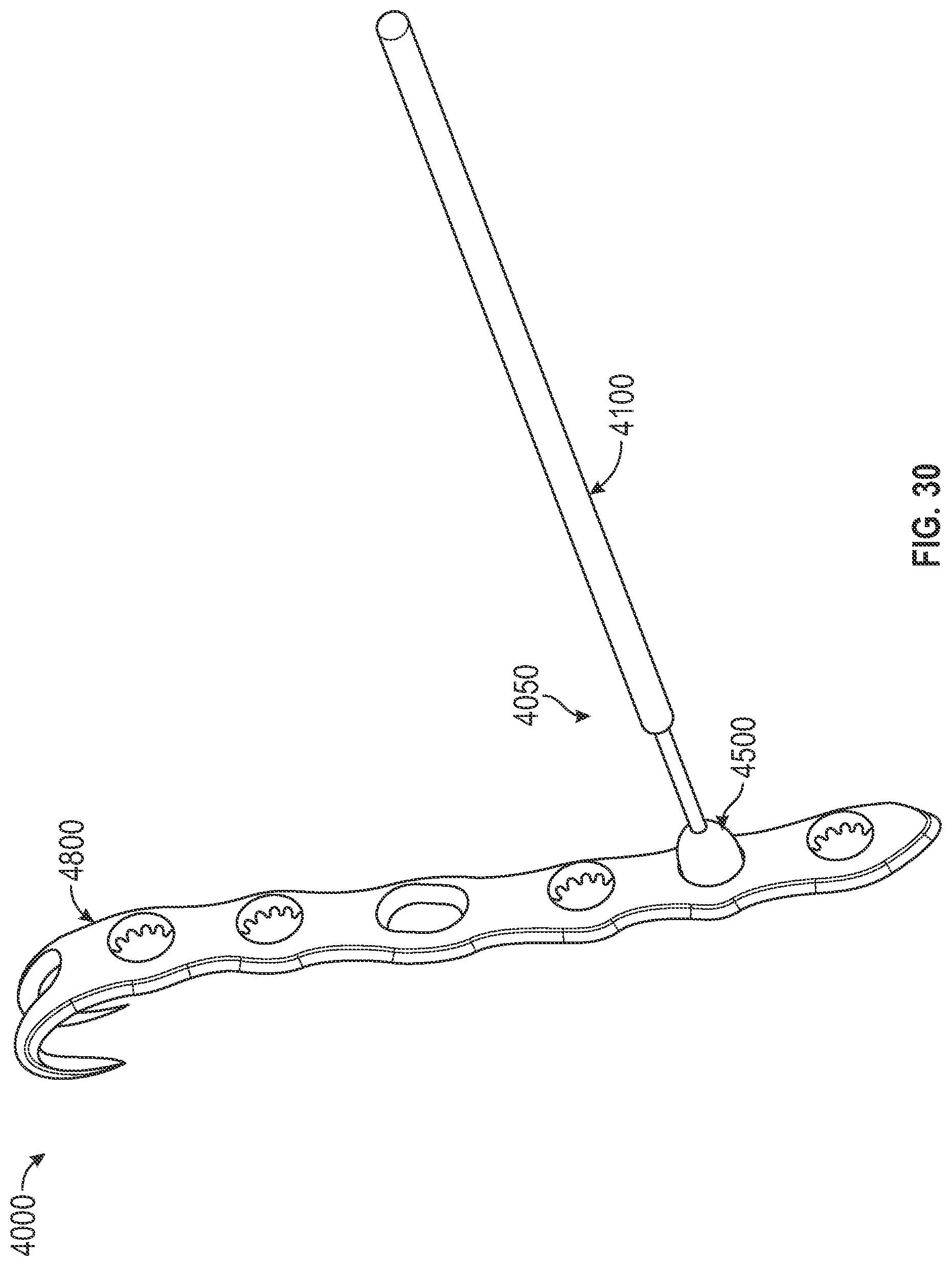 Patent US12310640 Figure 17 – Bone fixation devices, systems, kits, and methods