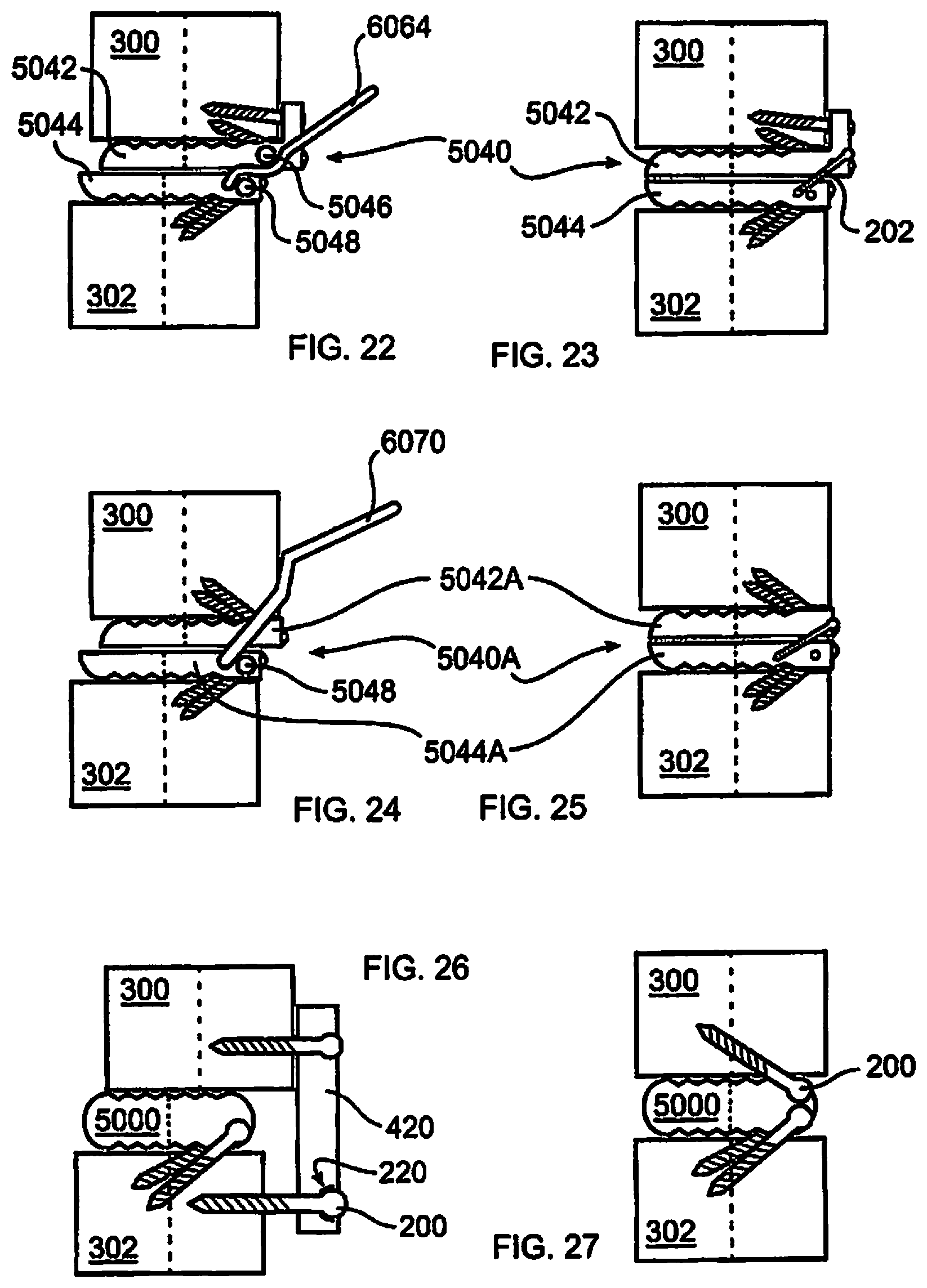 Patent US12310643 Figure 5 – Aligning vertebral bodies
