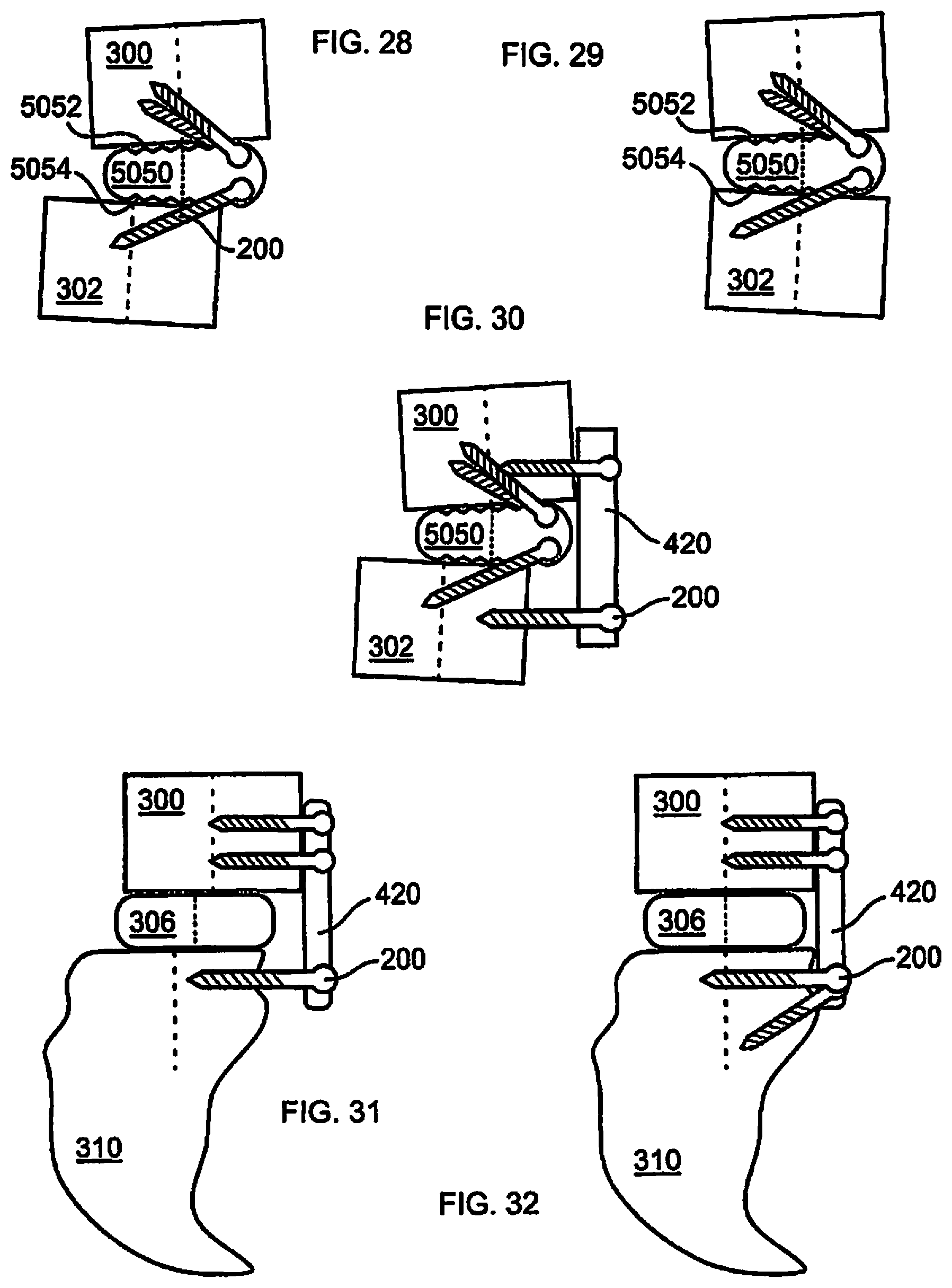 Patent US12310643 Figure 6 – Aligning vertebral bodies