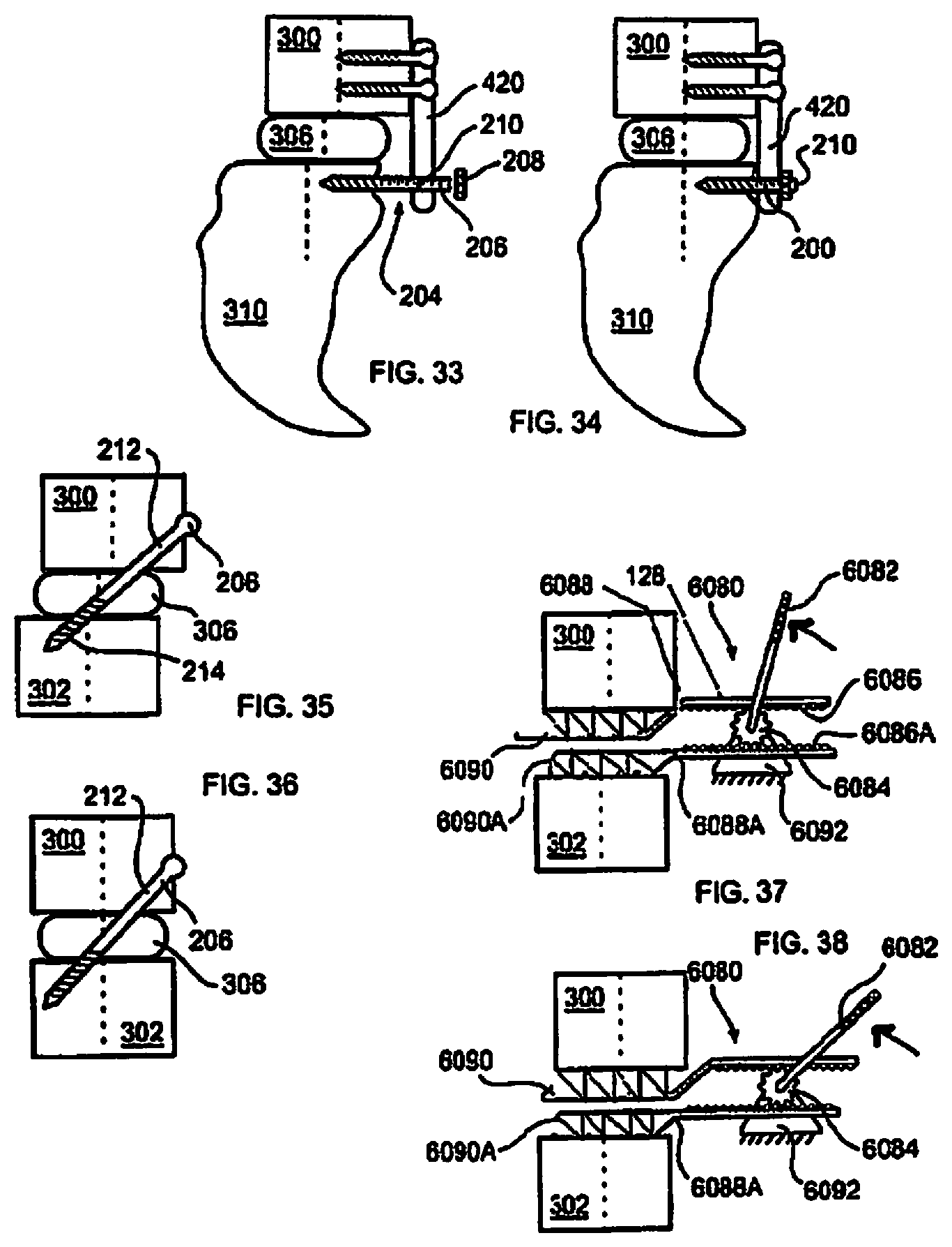 Patent US12310643 Figure 7 – Aligning vertebral bodies