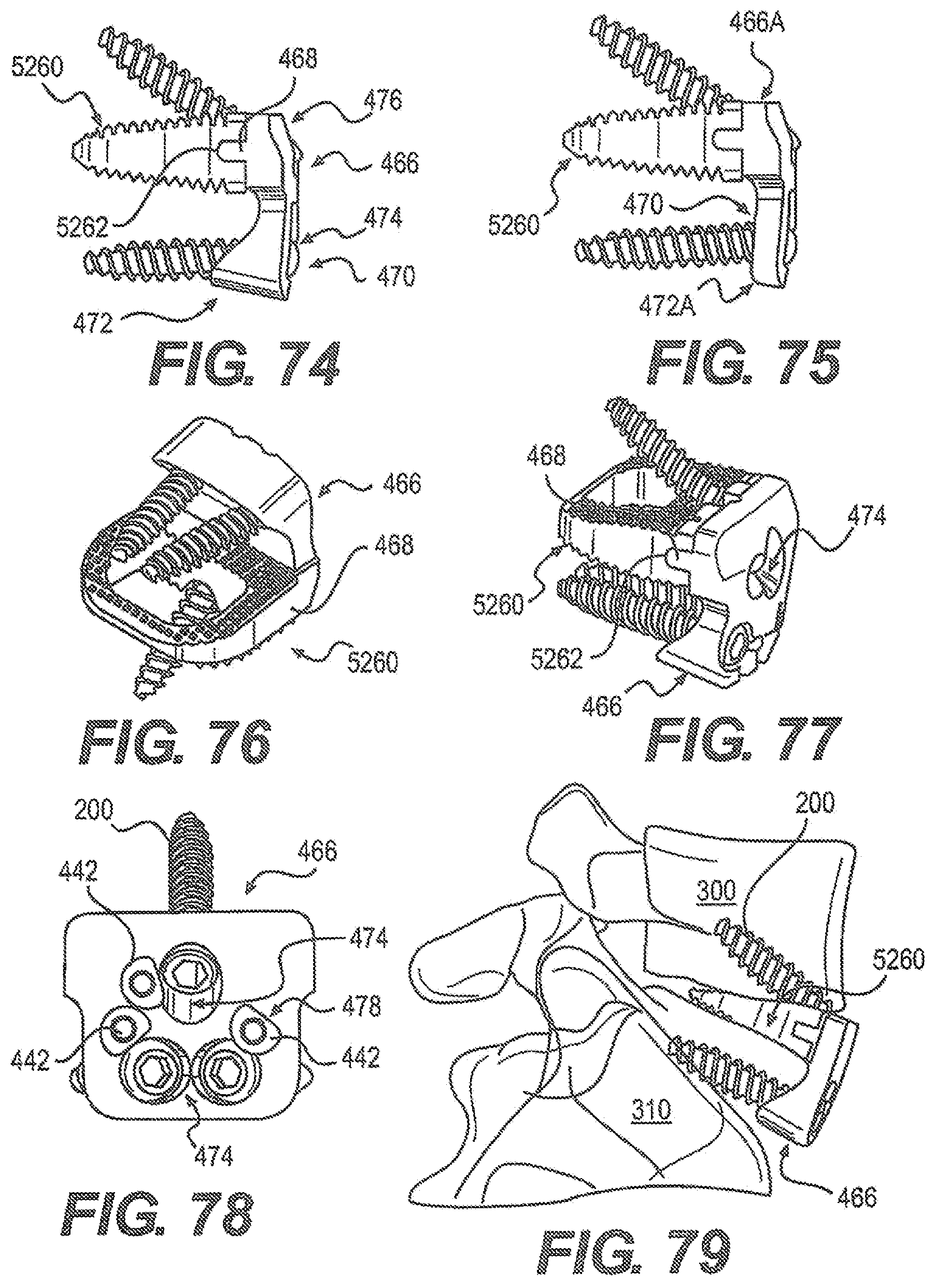 Patent US12310643 Figure 14 – Aligning vertebral bodies