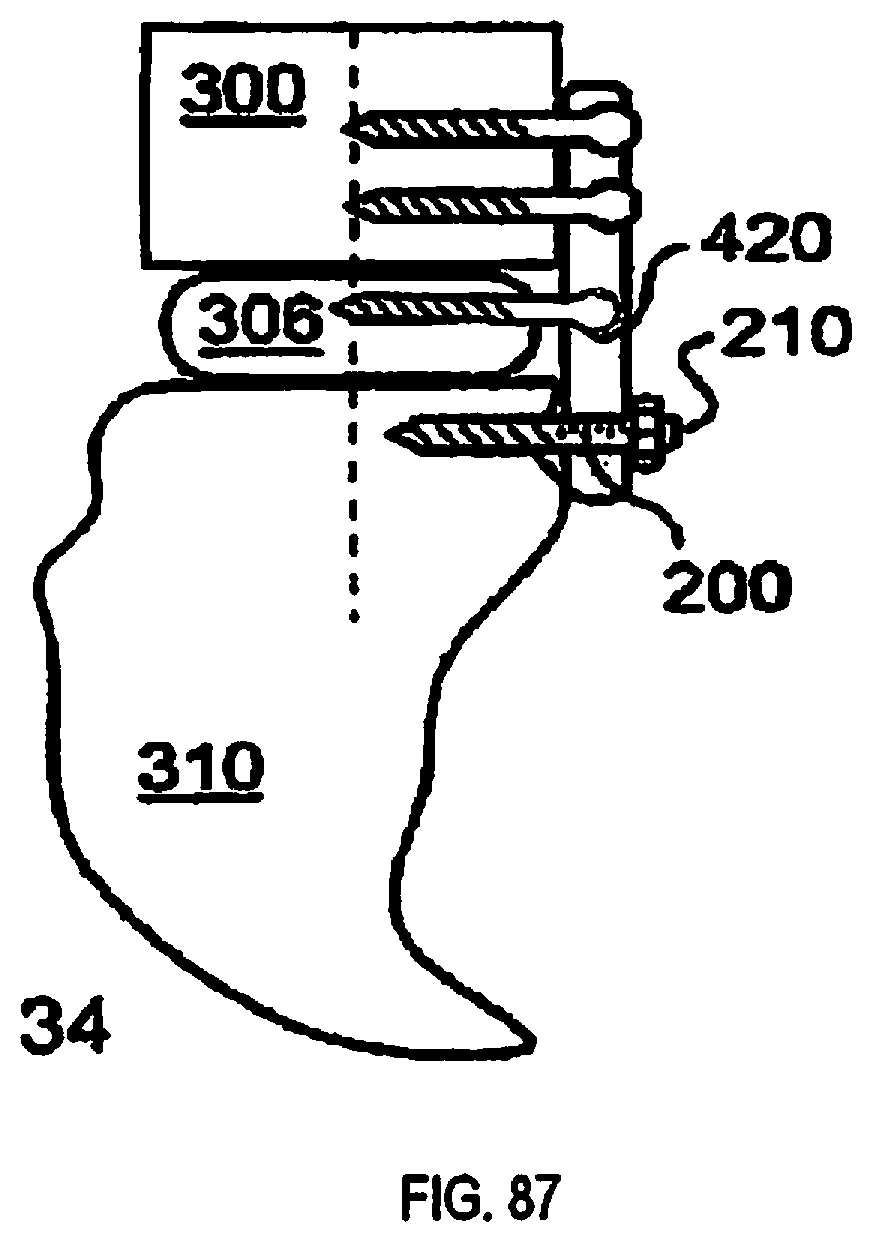 Patent US12310643 Figure 18 – Aligning vertebral bodies