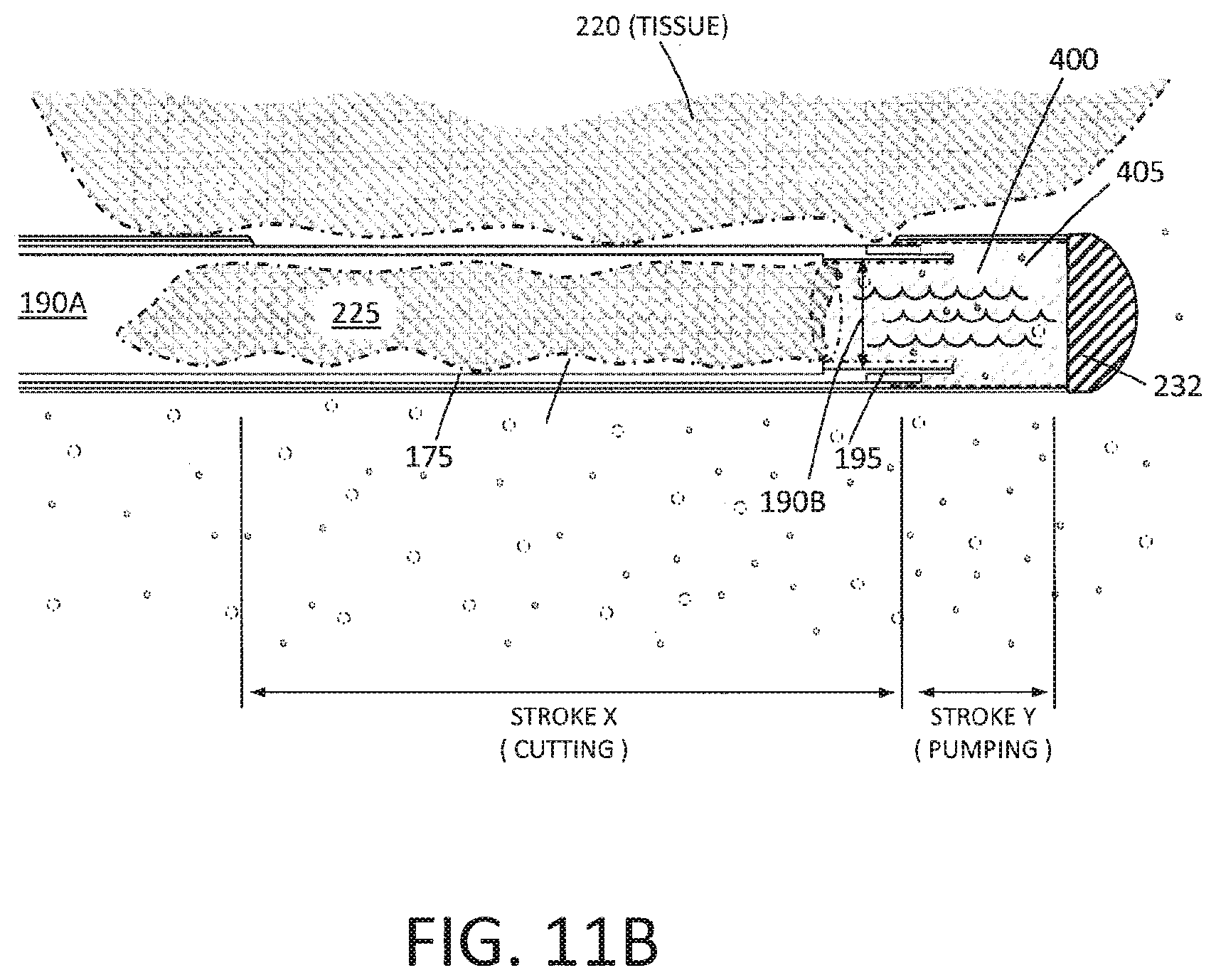Patent US12310649 Figure 12 – Tissue extraction devices and methods