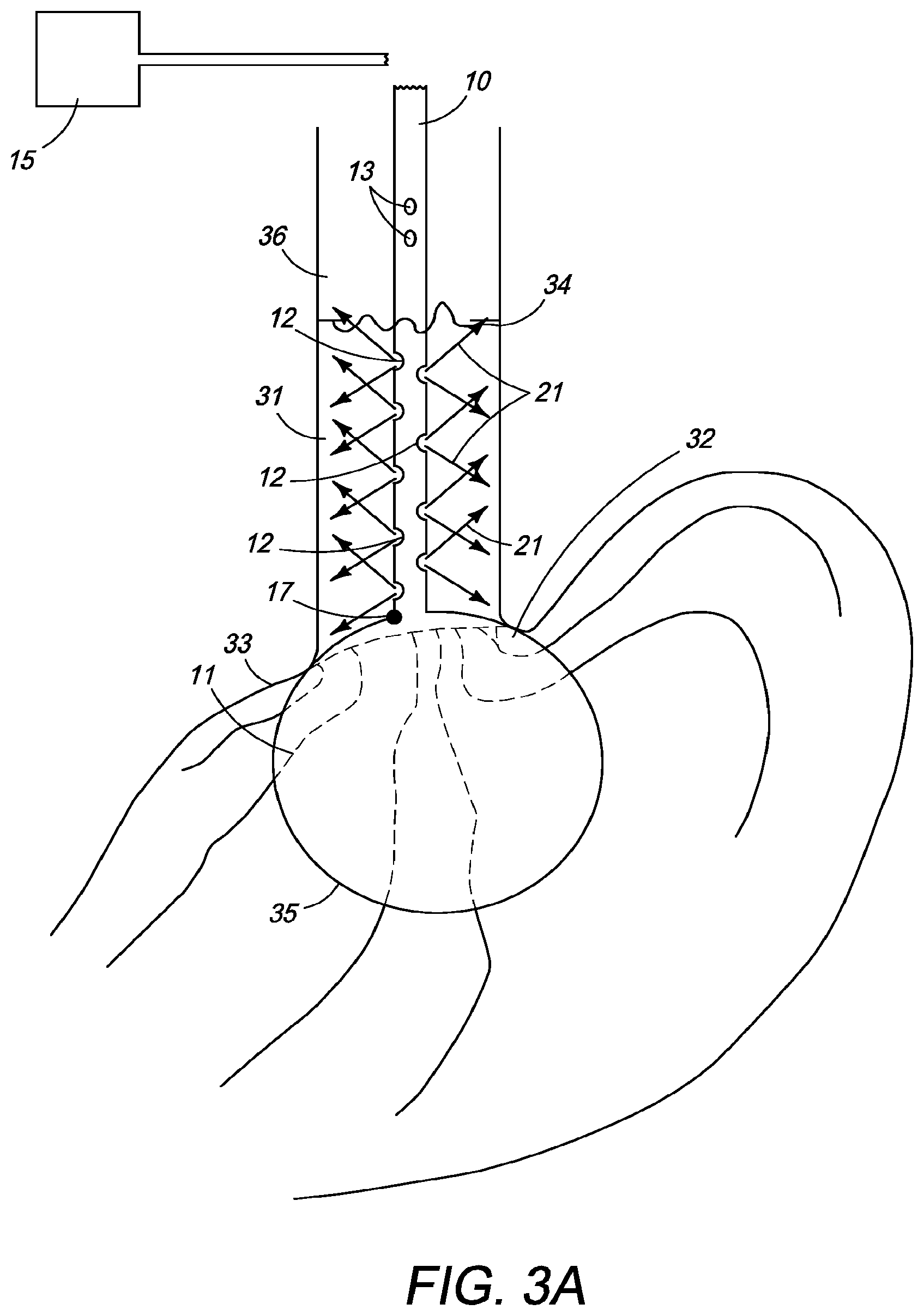 Patent US12310650 Figure 4 – Methods of ablating tissue using time-limited treatment periods