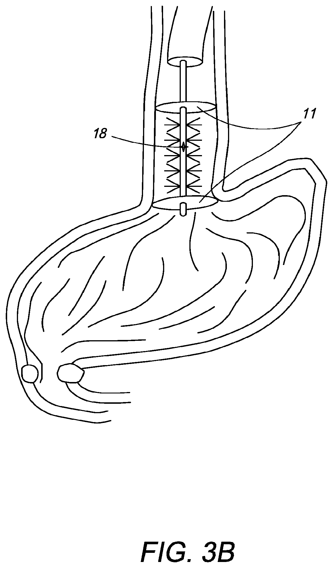 Patent US12310650 Figure 5 – Methods of ablating tissue using time-limited treatment periods