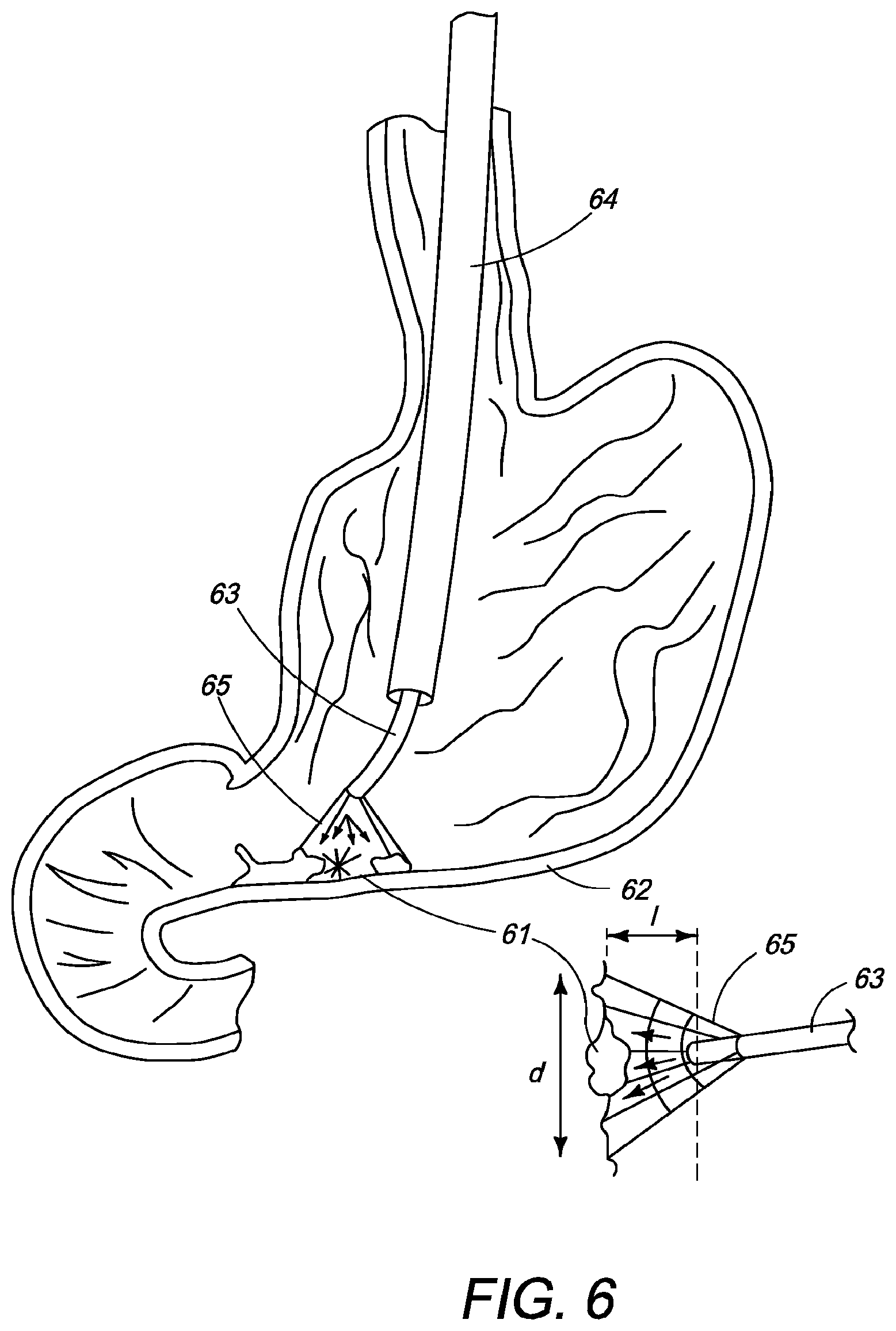 Patent US12310650 Figure 10 – Methods of ablating tissue using time-limited treatment periods