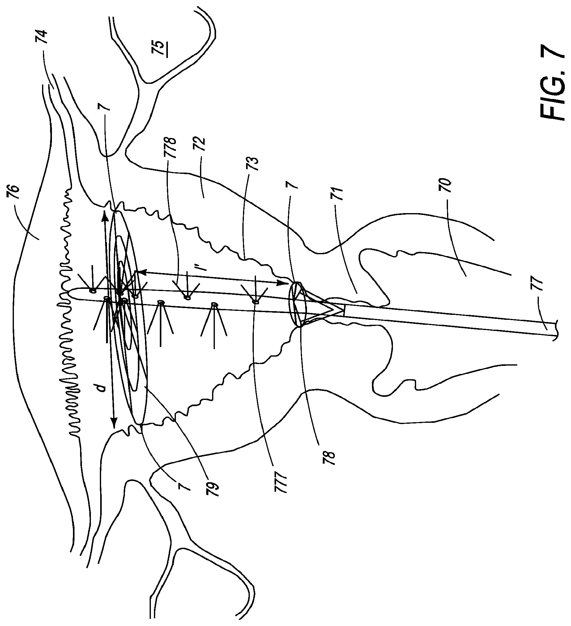 Patent US12310650 Figure 11 – Methods of ablating tissue using time-limited treatment periods