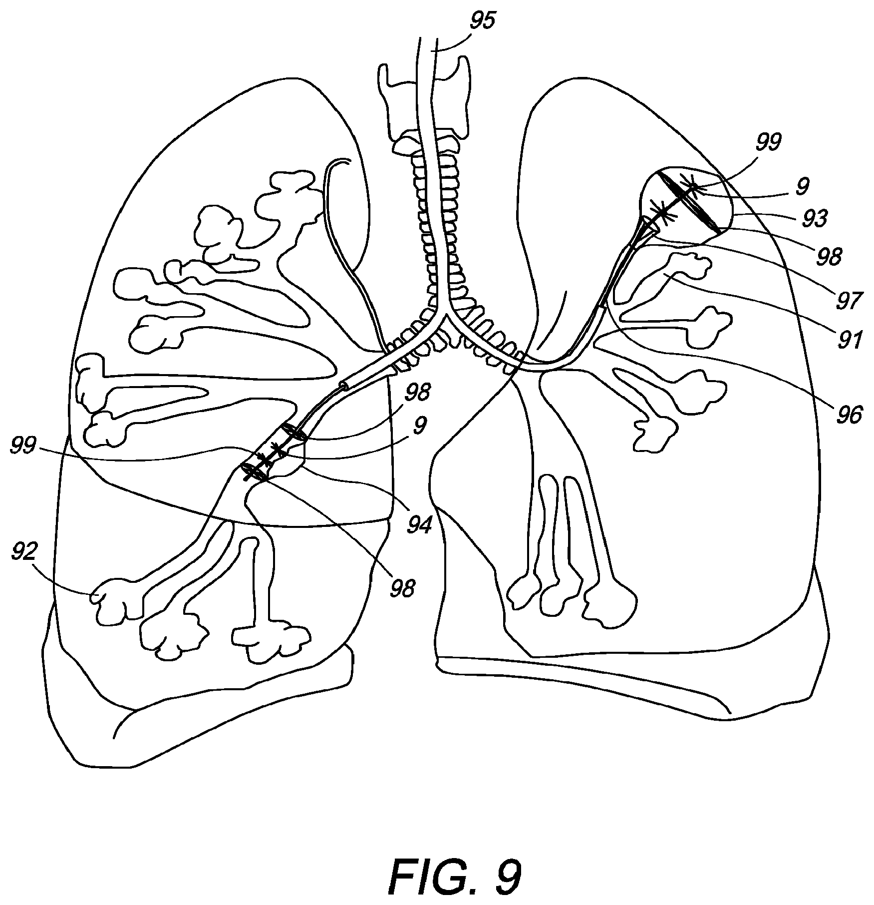 Patent US12310650 Figure 13 – Methods of ablating tissue using time-limited treatment periods
