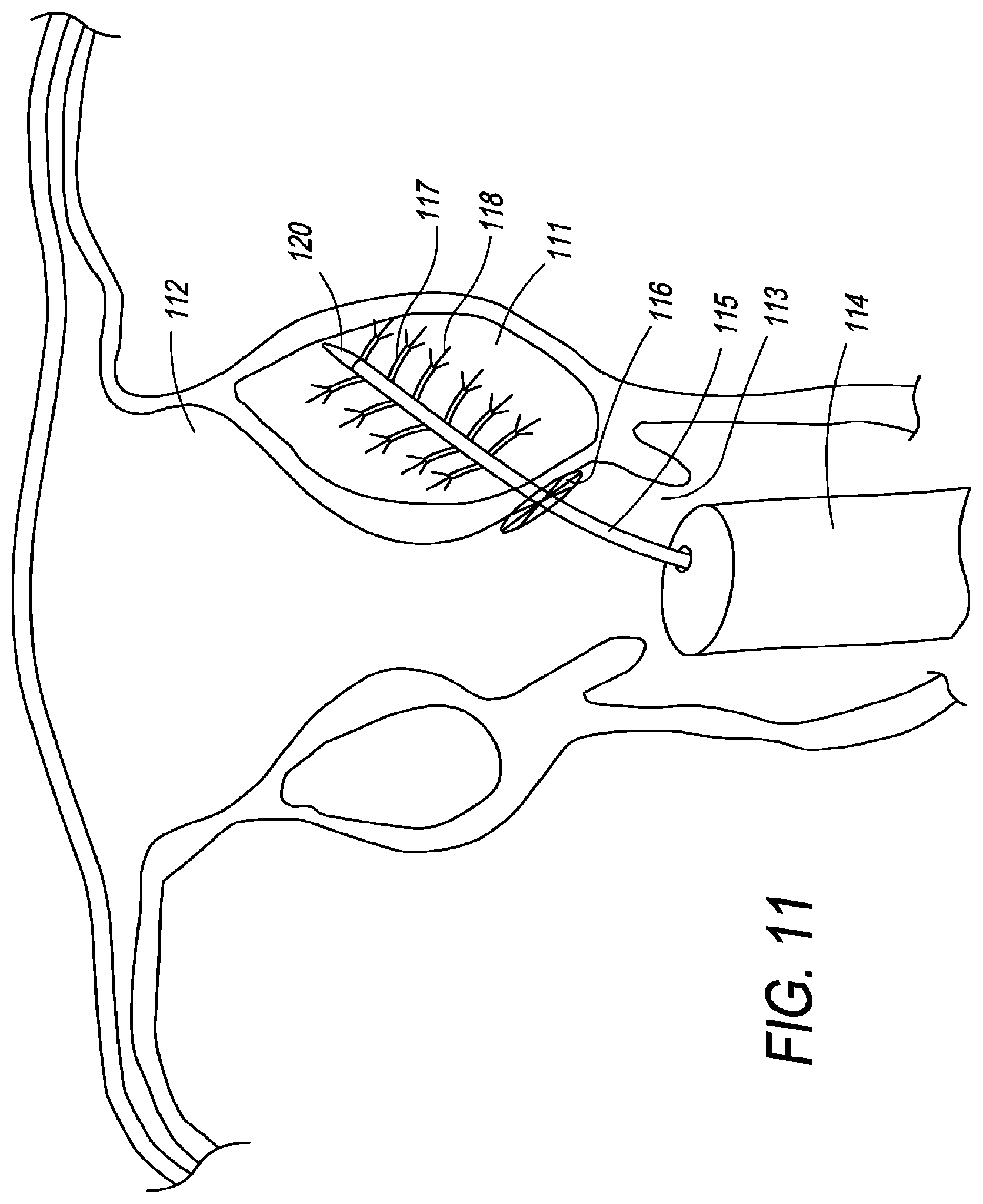 Patent US12310650 Figure 15 – Methods of ablating tissue using time-limited treatment periods