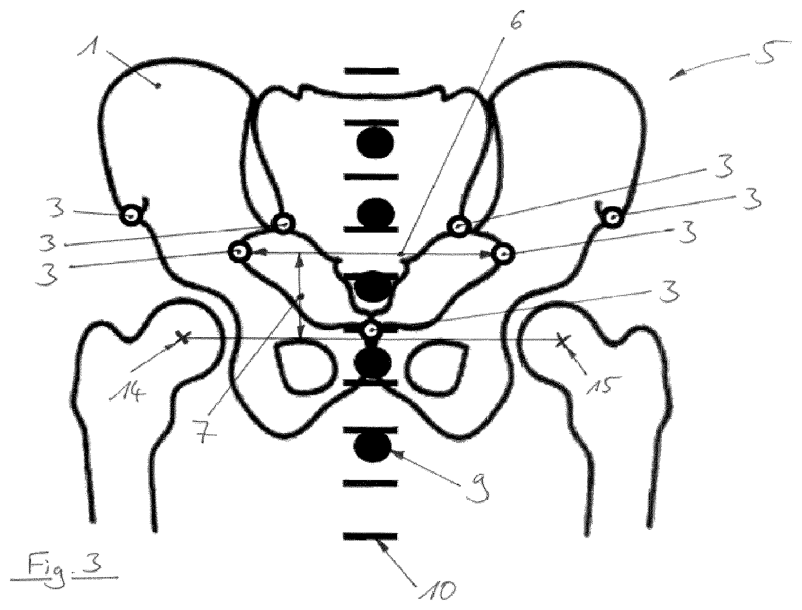 Patent US12310667 Figure 3 – Sagittal rotation determination