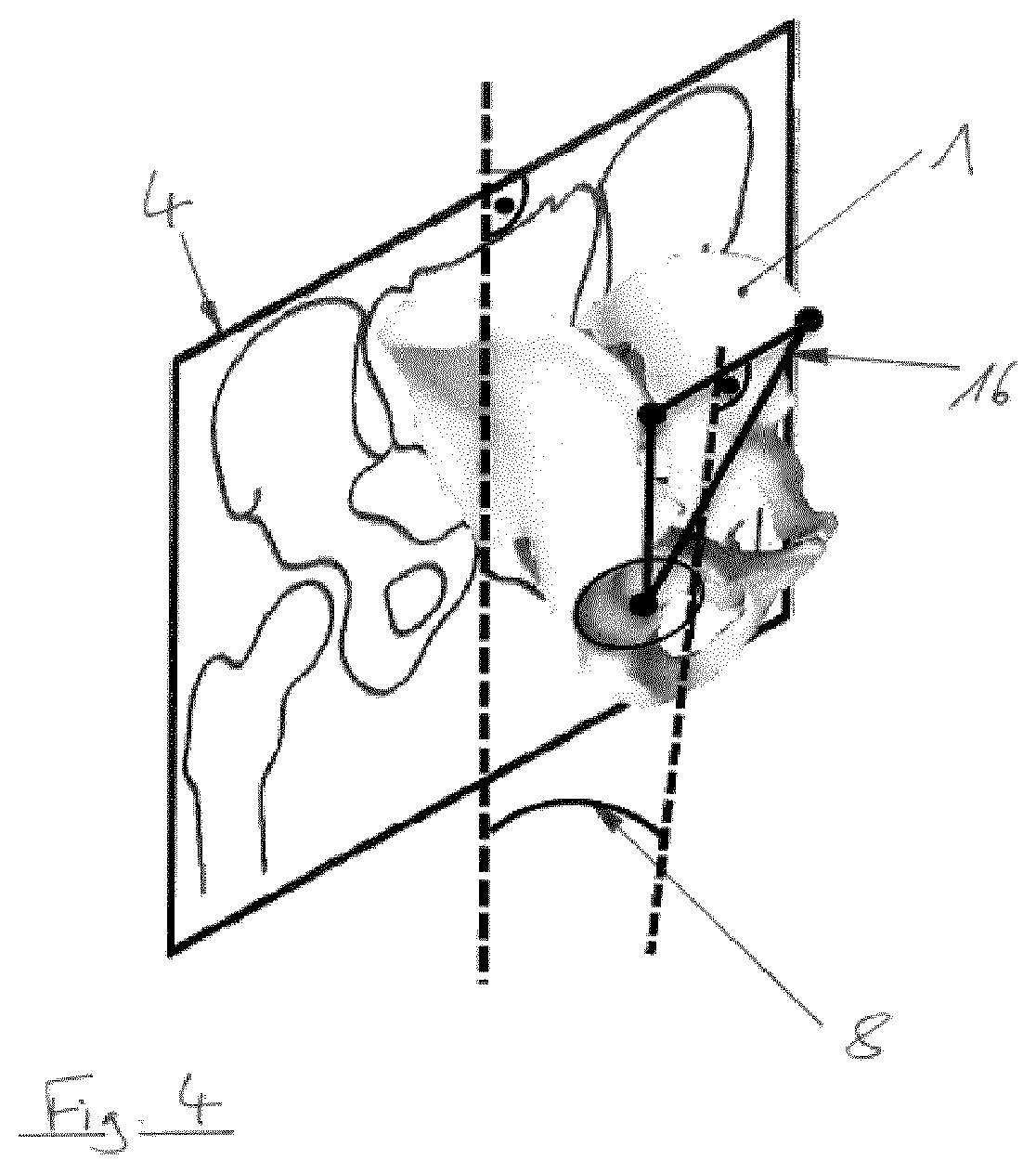Patent US12310667 Figure 4 – Sagittal rotation determination