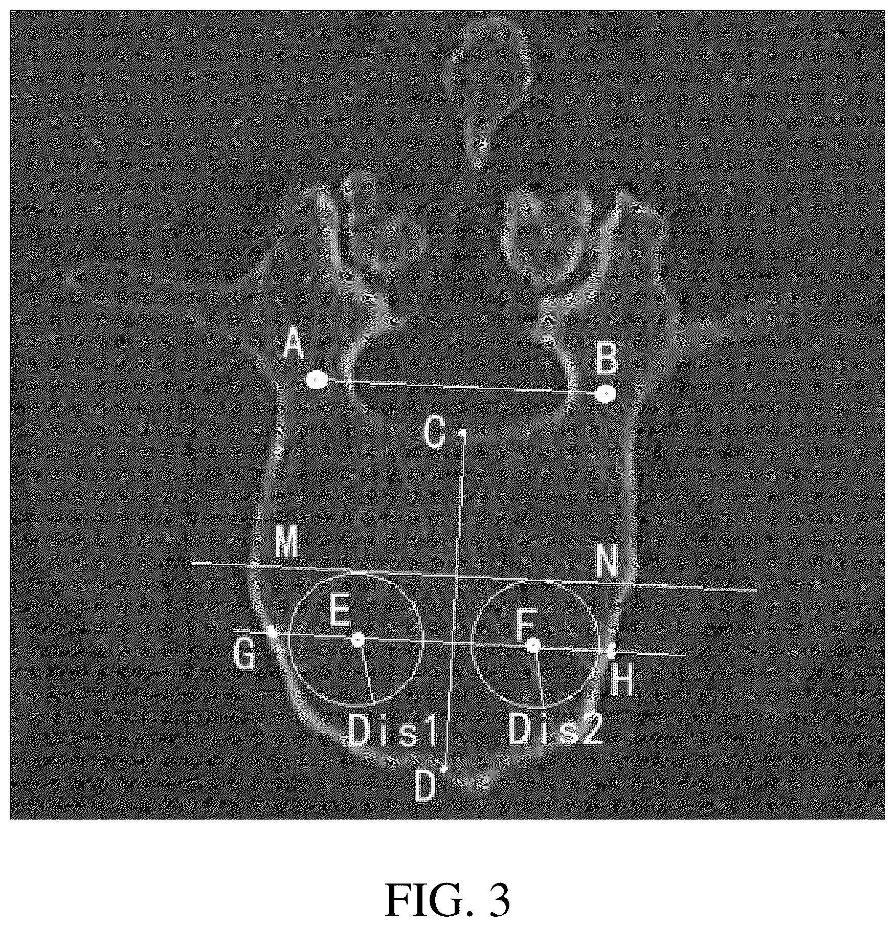 Patent US12310668 Figure 3 – Intelligent planning method, device, equipment and medium for puncture path in PVP surgery