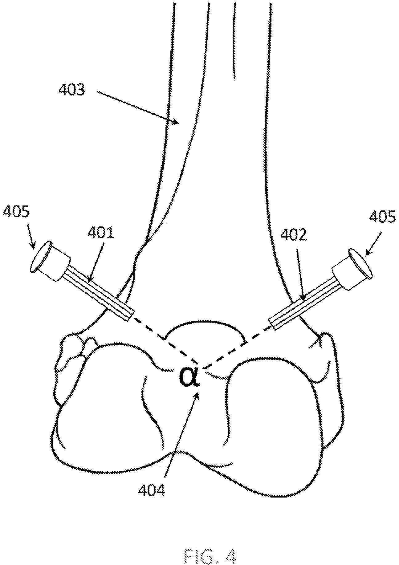 Patent US12310671 Figure 4 – Computer controlled surgical rotary tool