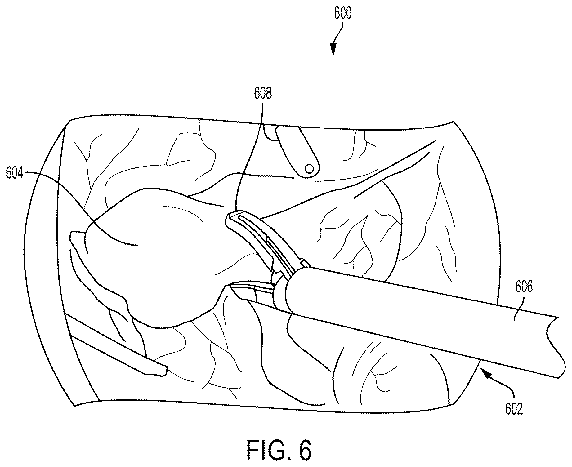 Patent US12310681 Figure 6 – Surgical system with augmented reality display