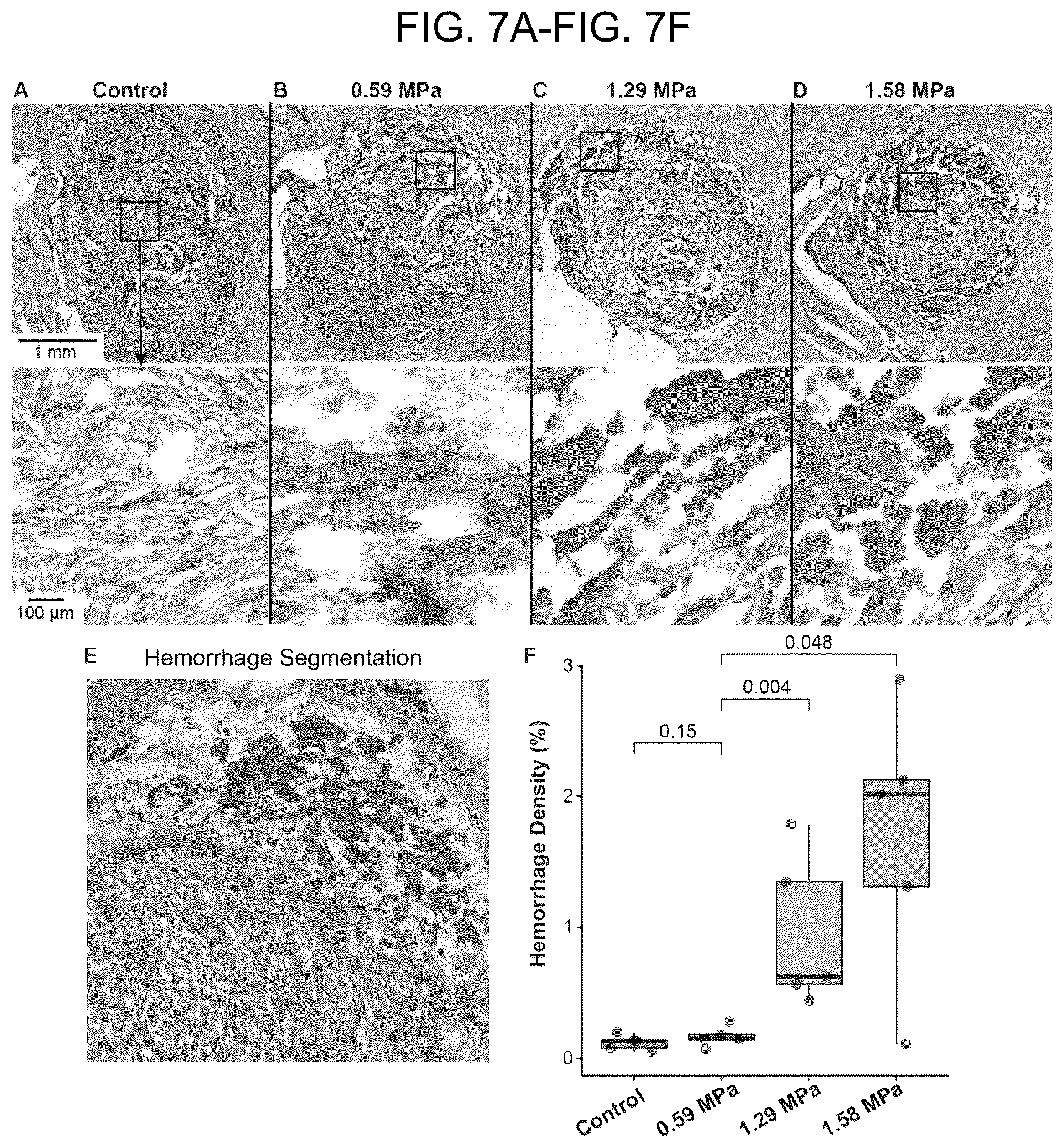 Patent US12310697 Figure 5 – Methods and systems for noninvasive and localized brain liquid biopsy using focused ultrasound