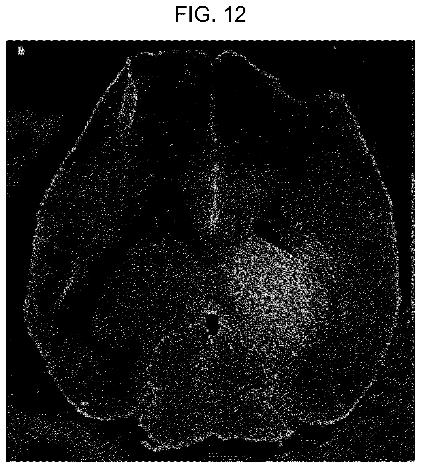Patent US12310697 Figure 10 – Methods and systems for noninvasive and localized brain liquid biopsy using focused ultrasound