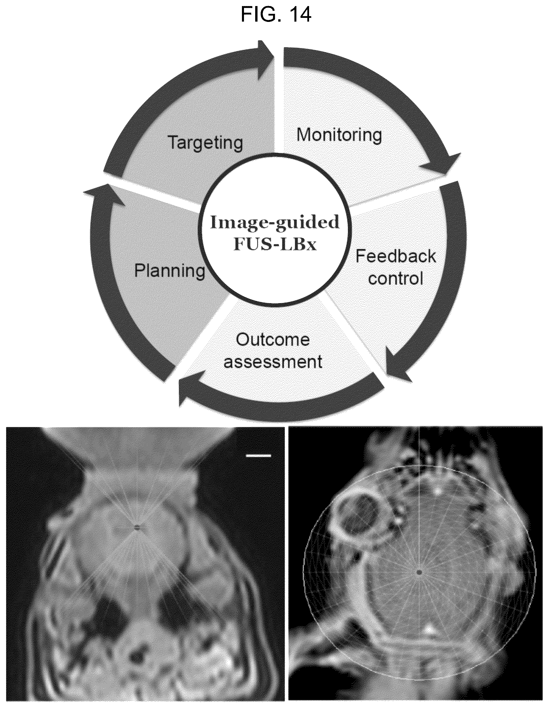 Patent US12310697 Figure 12 – Methods and systems for noninvasive and localized brain liquid biopsy using focused ultrasound