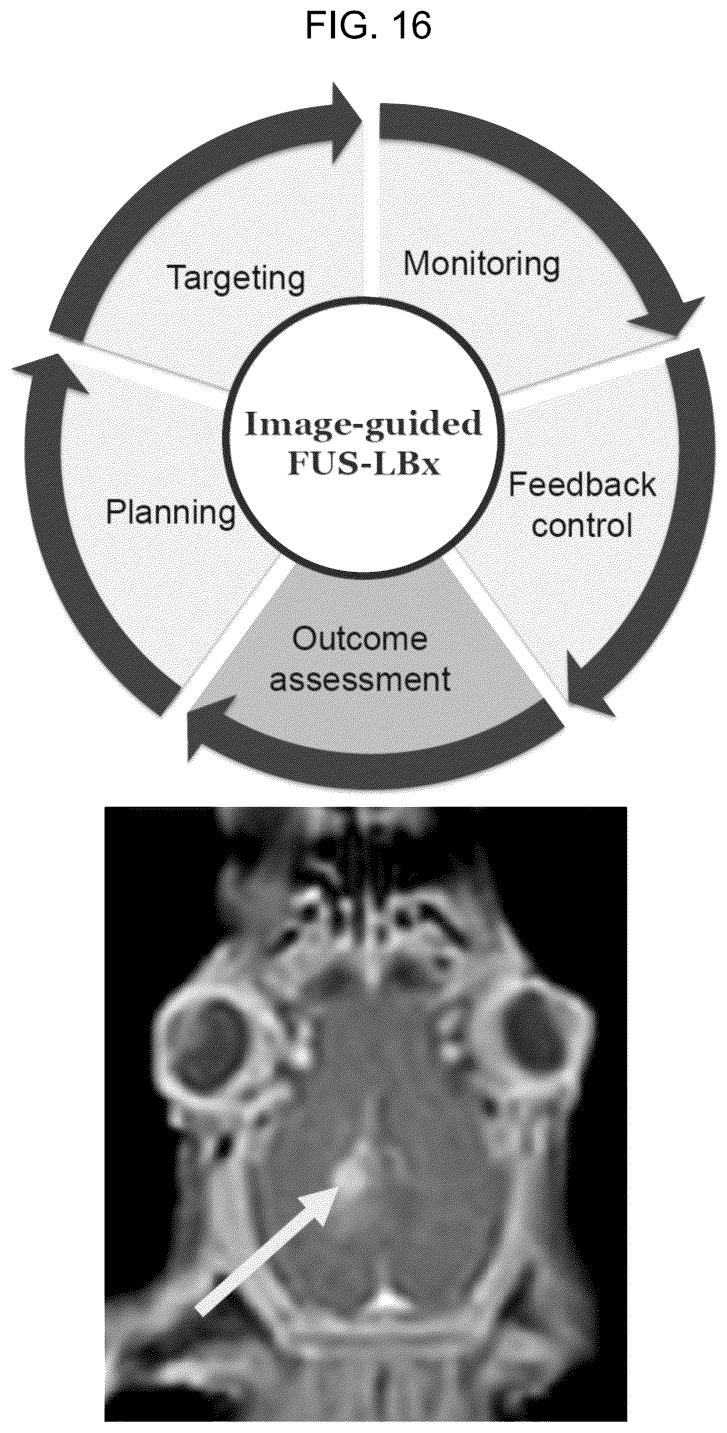 Patent US12310697 Figure 14 – Methods and systems for noninvasive and localized brain liquid biopsy using focused ultrasound