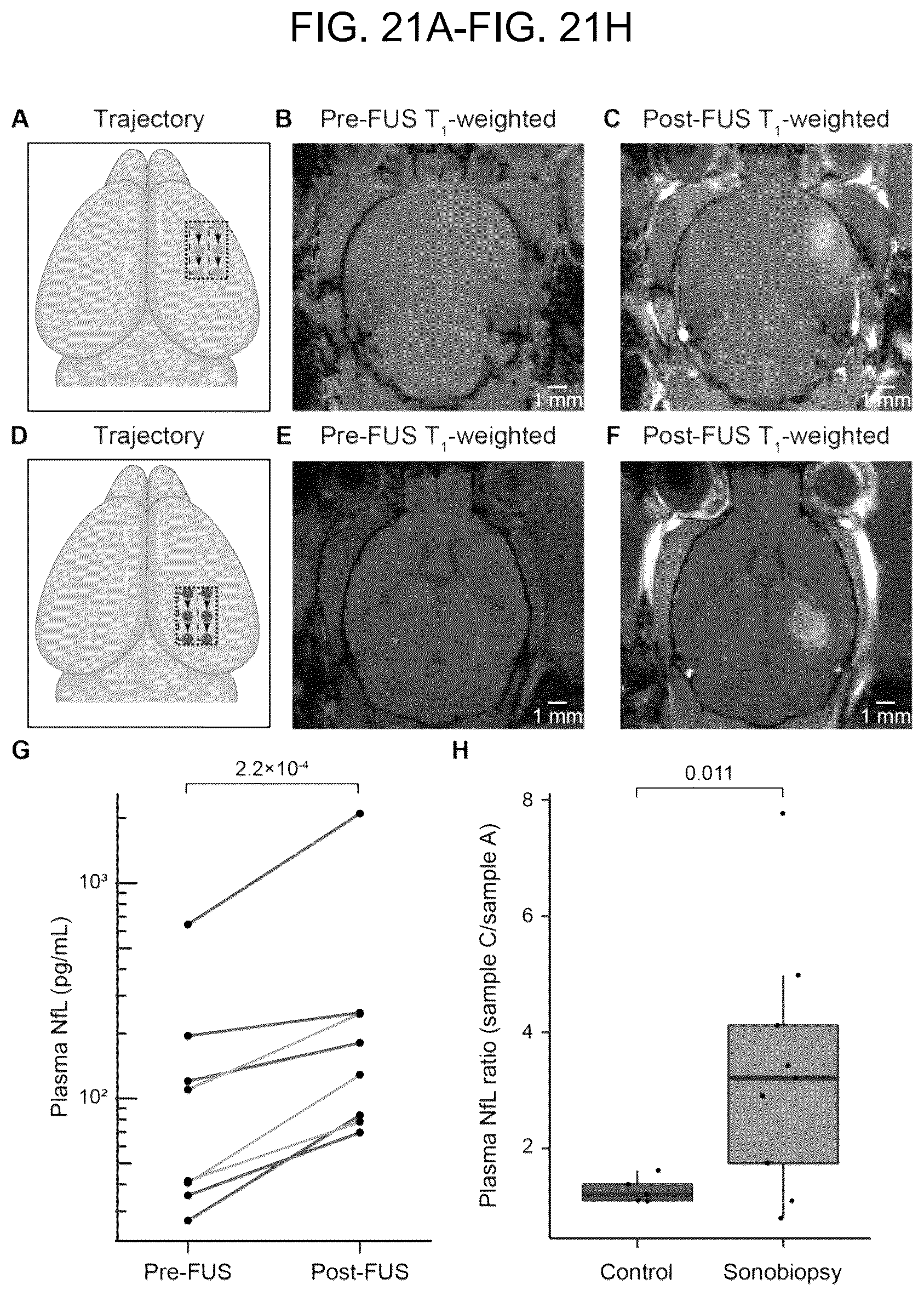 Patent US12310697 Figure 19 – Methods and systems for noninvasive and localized brain liquid biopsy using focused ultrasound