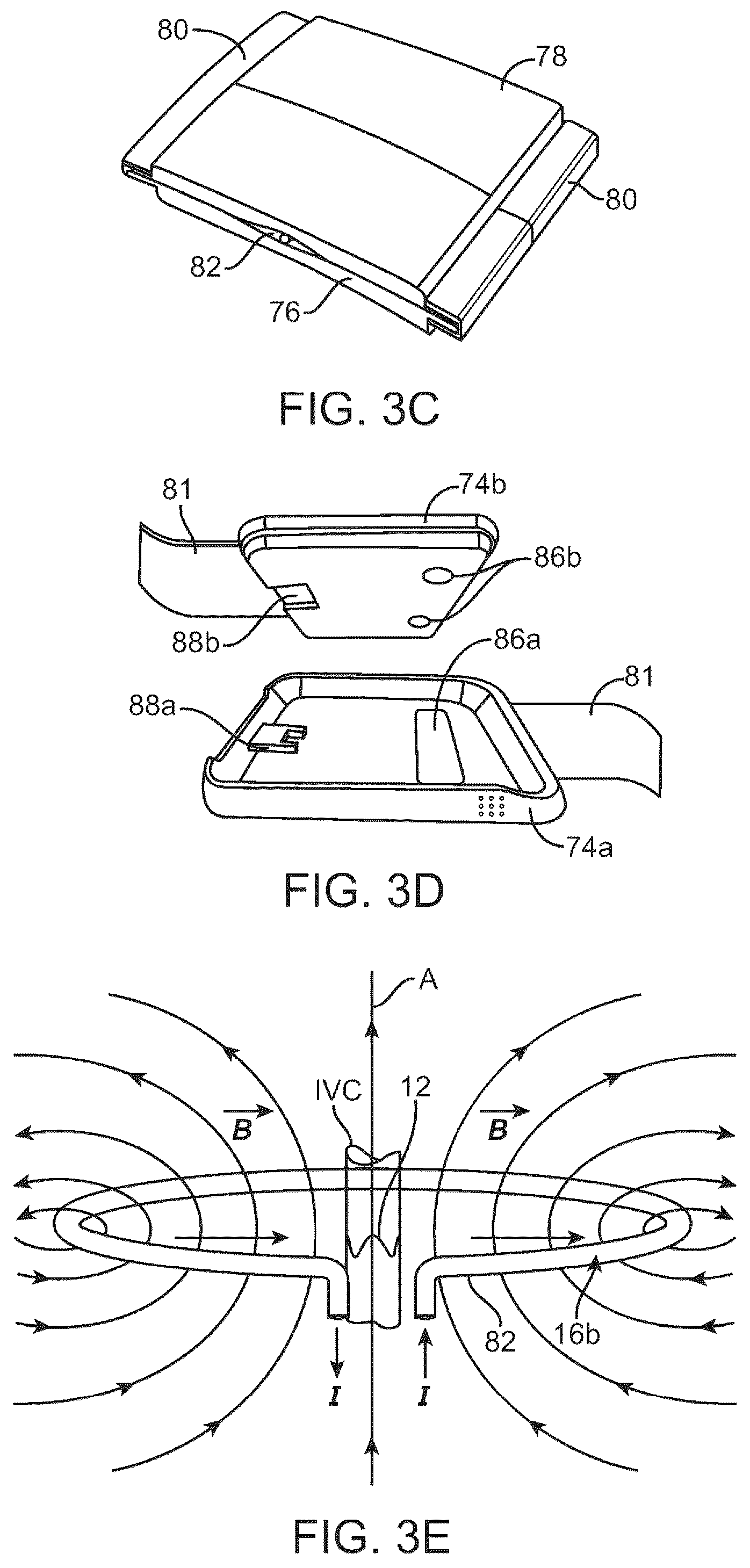 Patent US12310707 Figure 5 – Wireless resonant circuit and variable inductance vascular monitoring implants and anchoring structures therefore