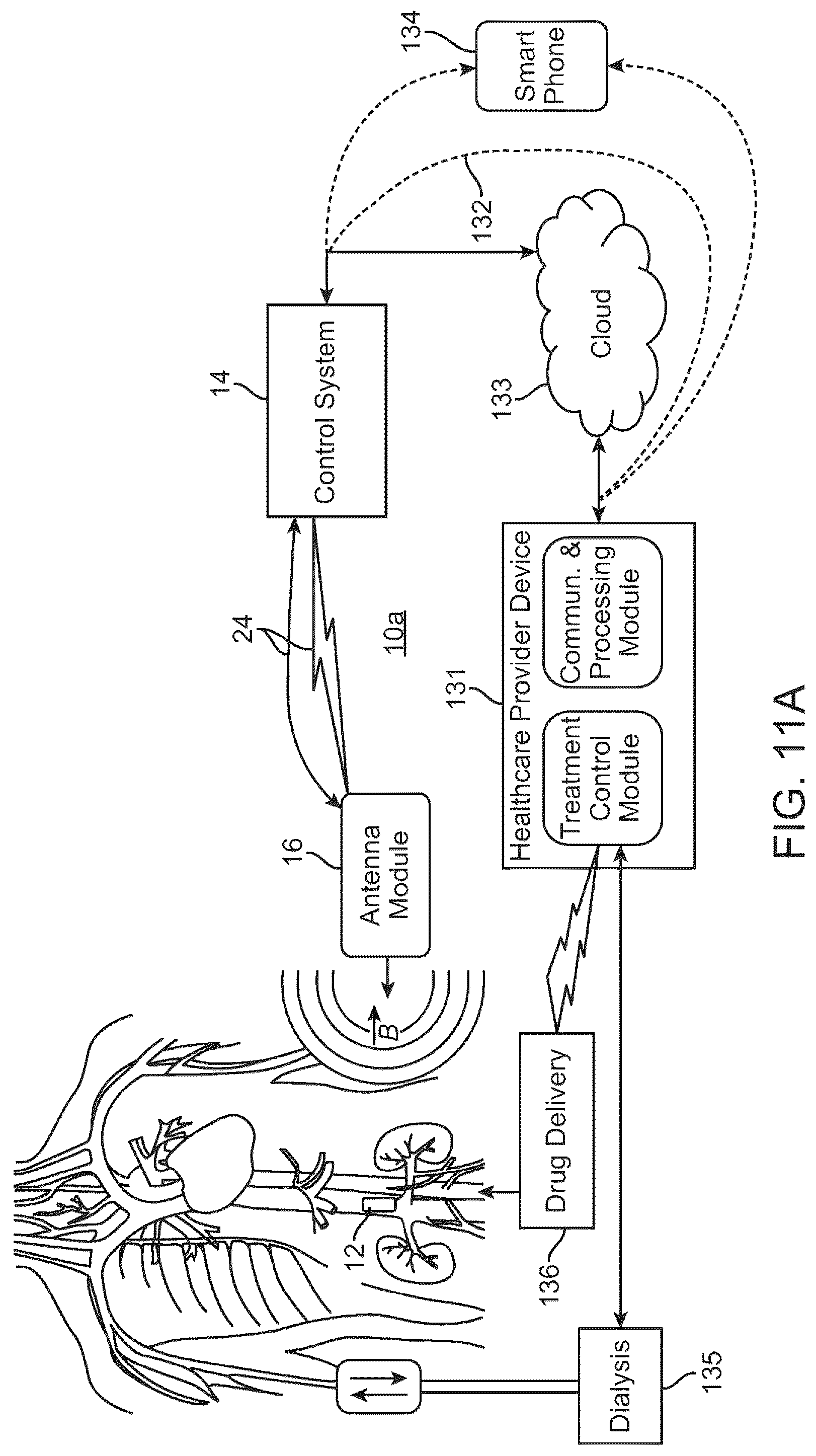 Patent US12310707 Figure 13 – Wireless resonant circuit and variable inductance vascular monitoring implants and anchoring structures therefore