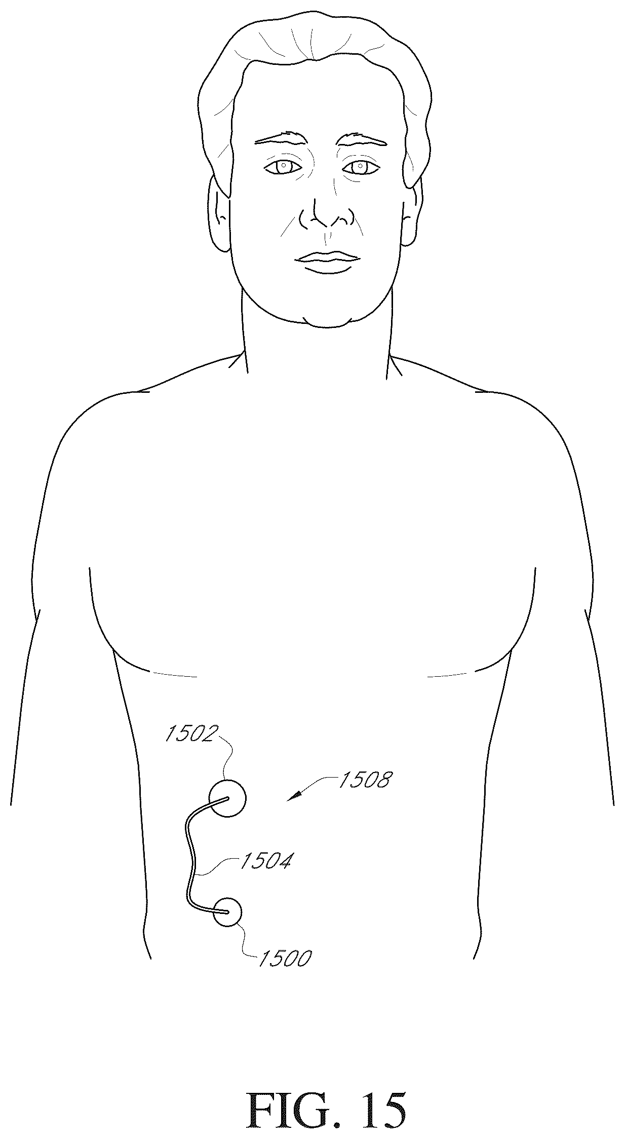 Patent US12310723 Figure 18 – Advanced continuous analyte monitoring system