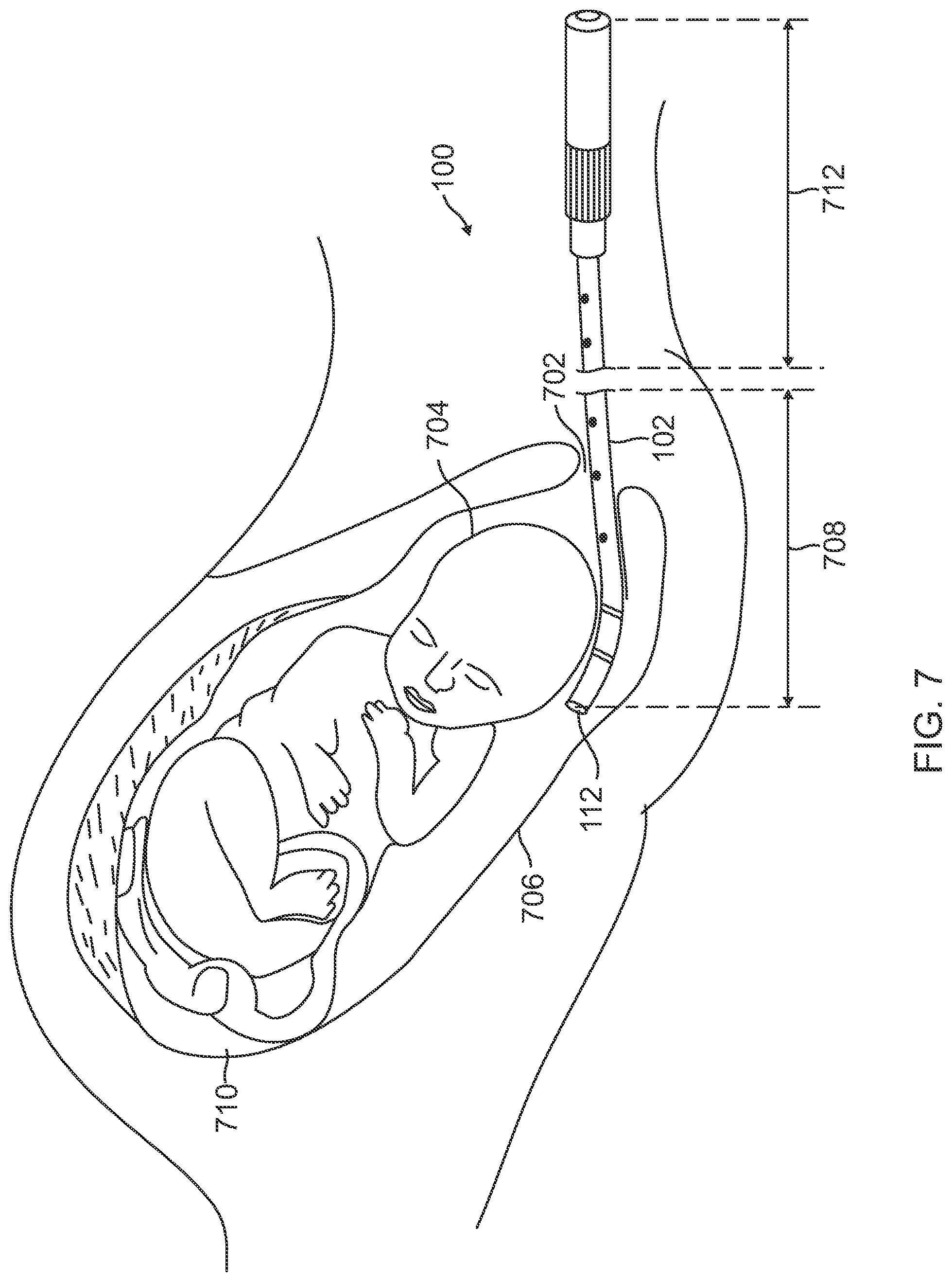Patent US12310733 Figure 5 – Intrauterine access catheter for delivering and facilitating operation of a medical apparatus for assisting parturition