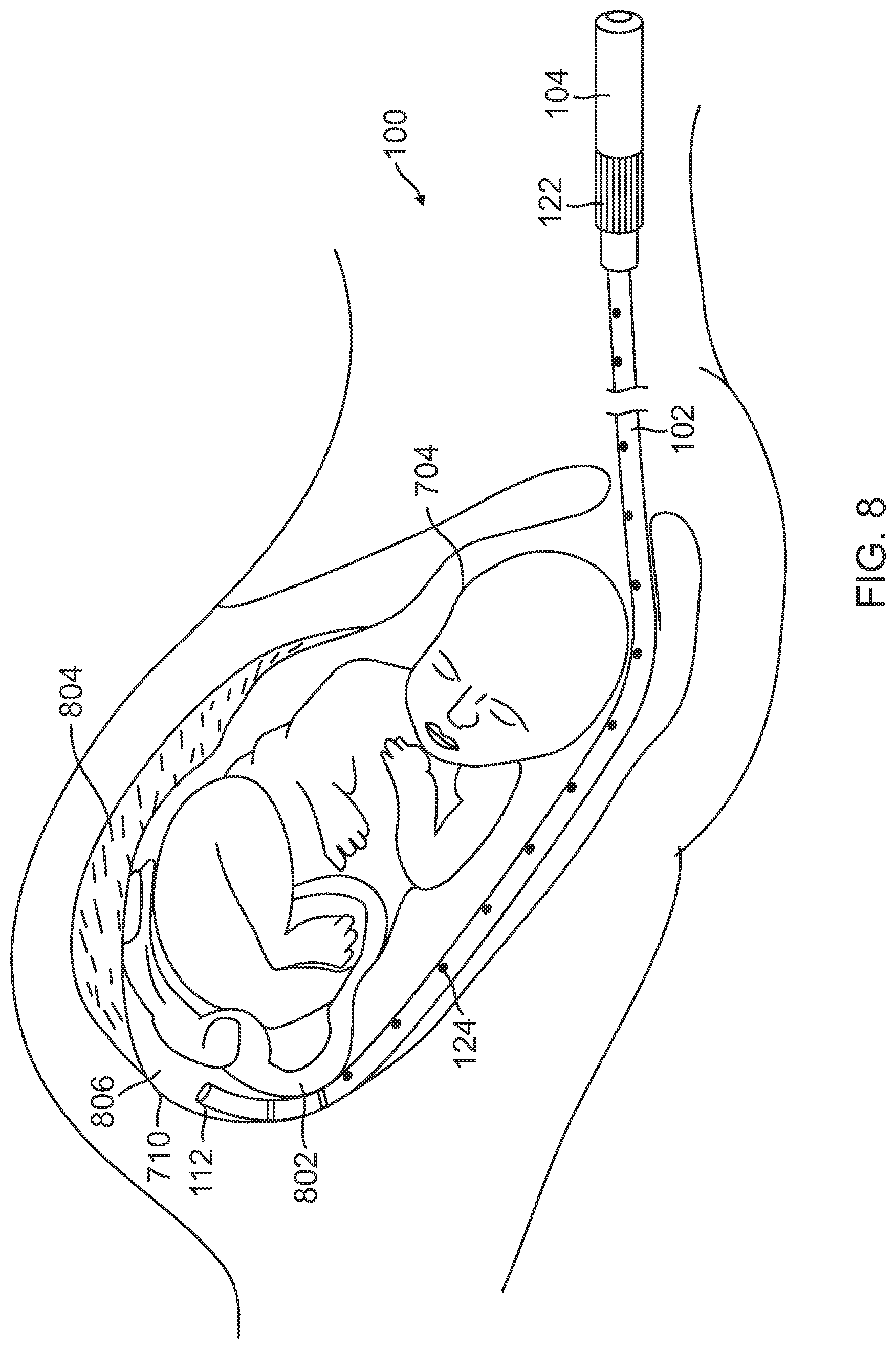 Patent US12310733 Figure 6 – Intrauterine access catheter for delivering and facilitating operation of a medical apparatus for assisting parturition