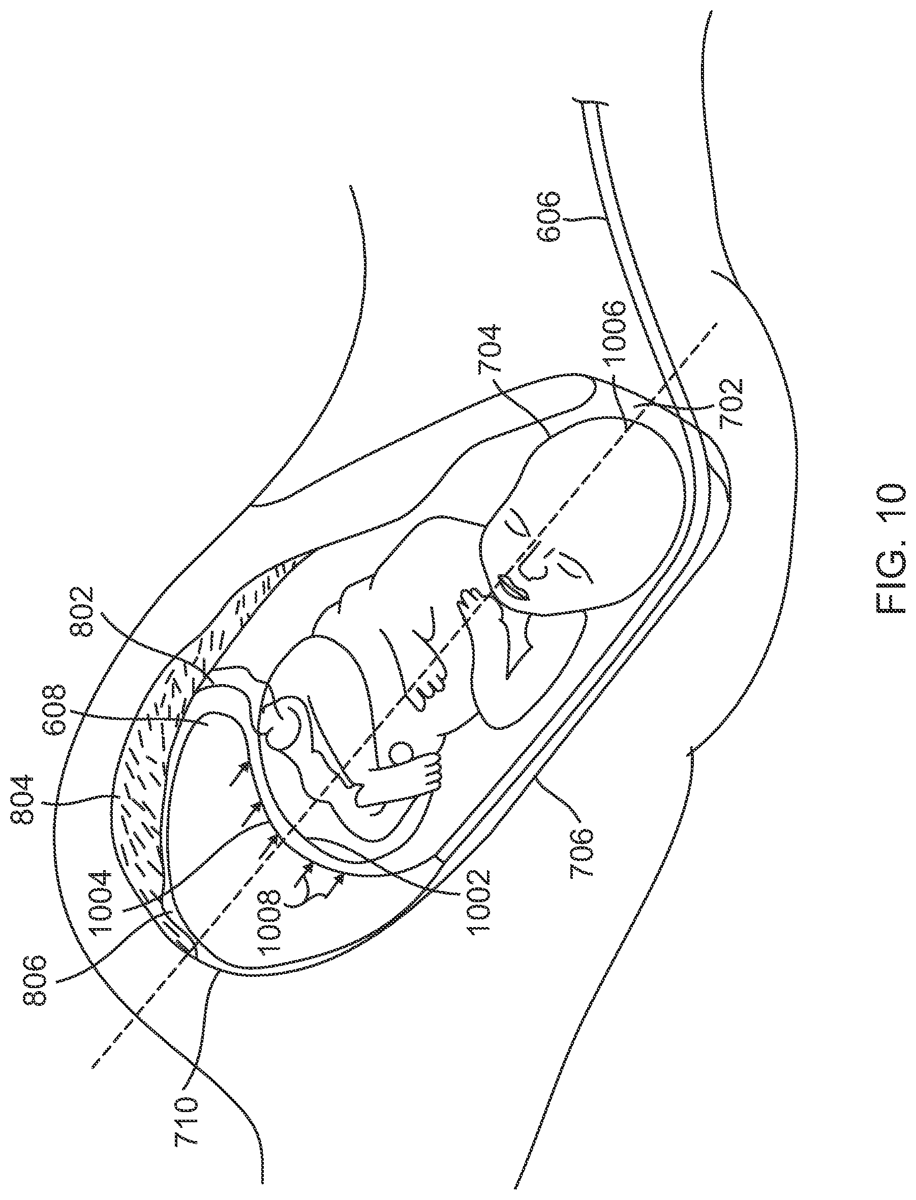 Patent US12310733 Figure 7 – Intrauterine access catheter for delivering and facilitating operation of a medical apparatus for assisting parturition