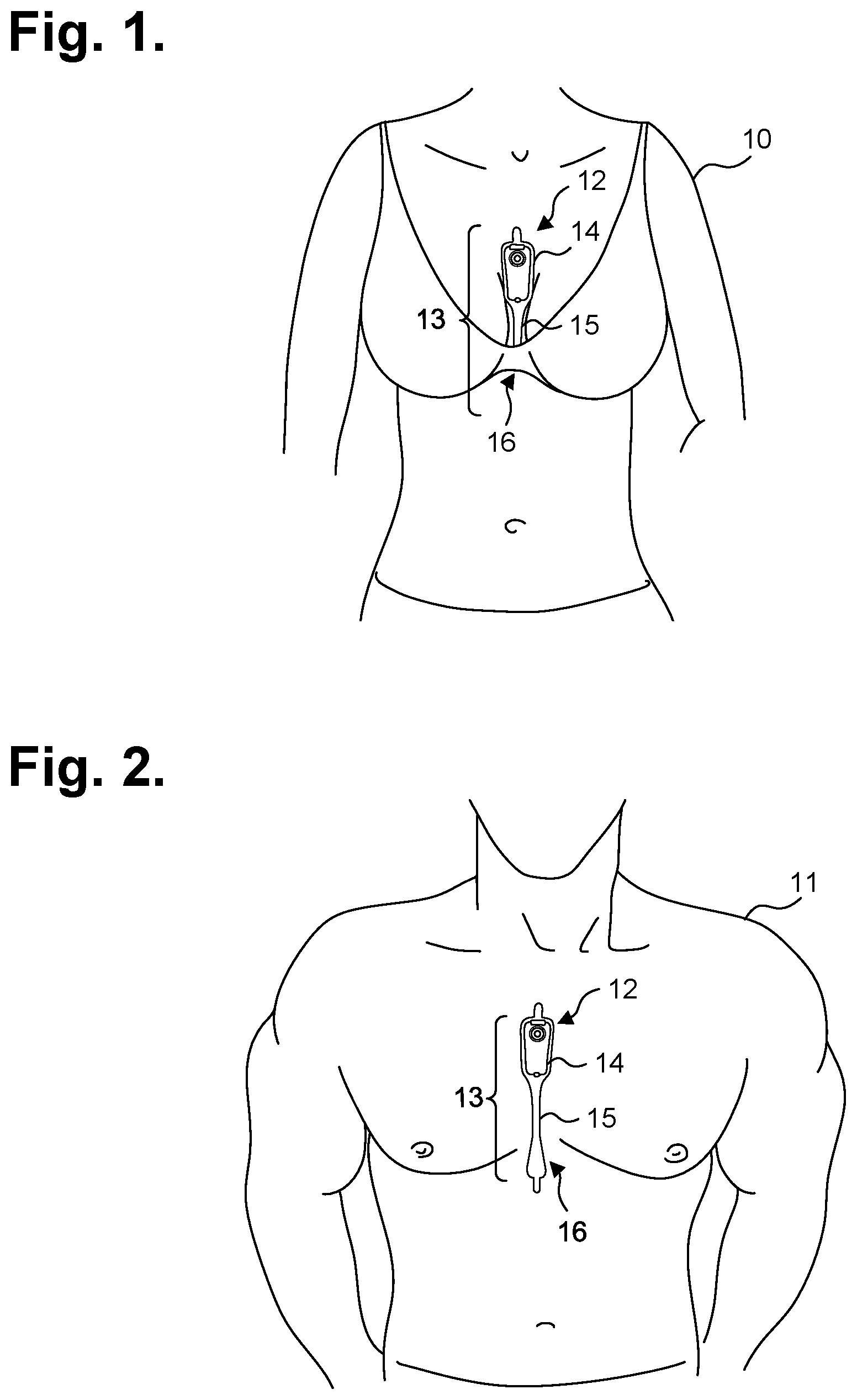 Patent US12310735 Figure 1 – Extended wear ambulatory electrocardiography monitor