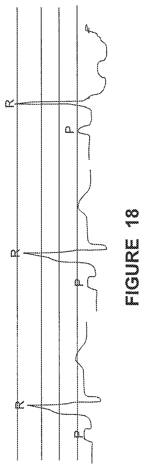 Patent US12310740 Figure 20 – Detecting or validating a detection of a state change from a template of heart rate derivative shape or heart beat wave complex