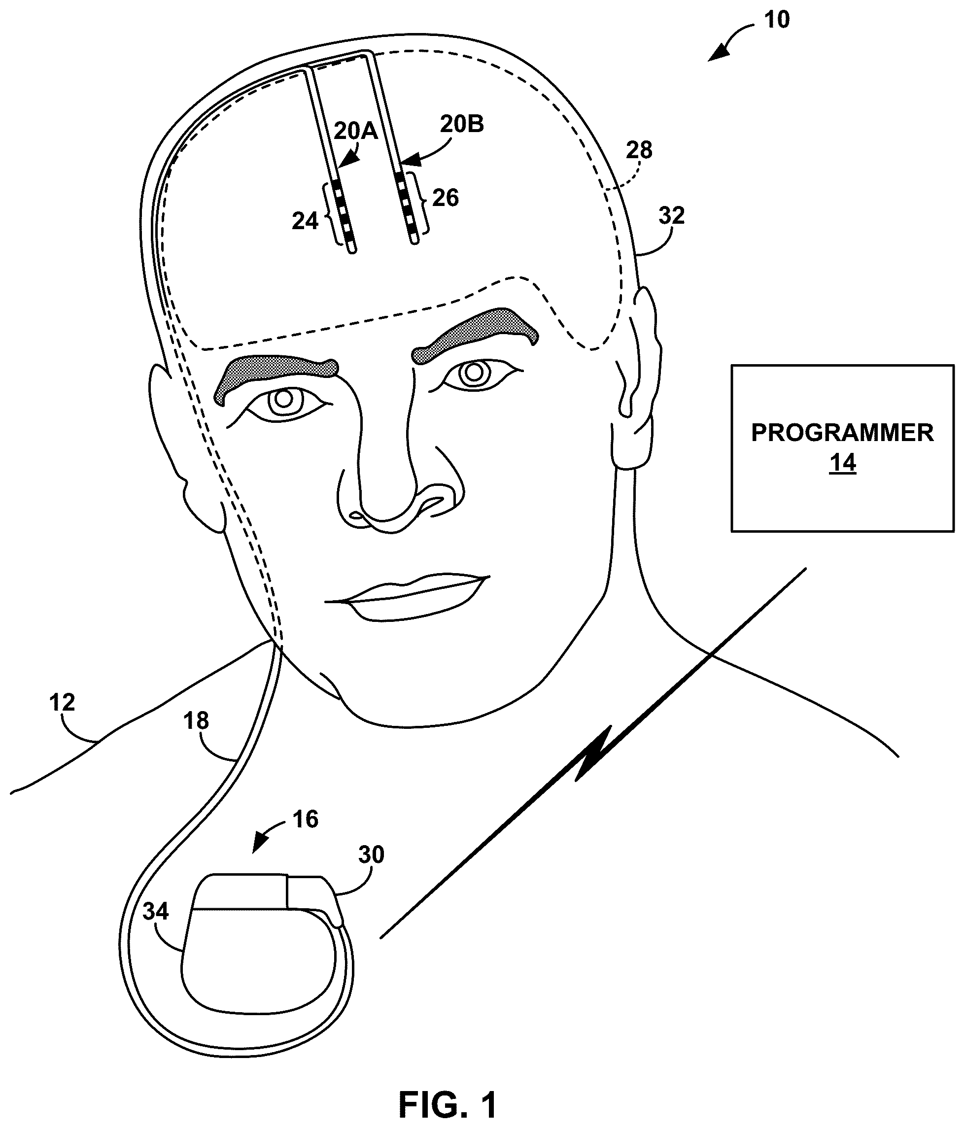 Patent US12310744 Figure 1 – Patient state determination based on one or more spectral characteristics of a bioelectrical brain signal