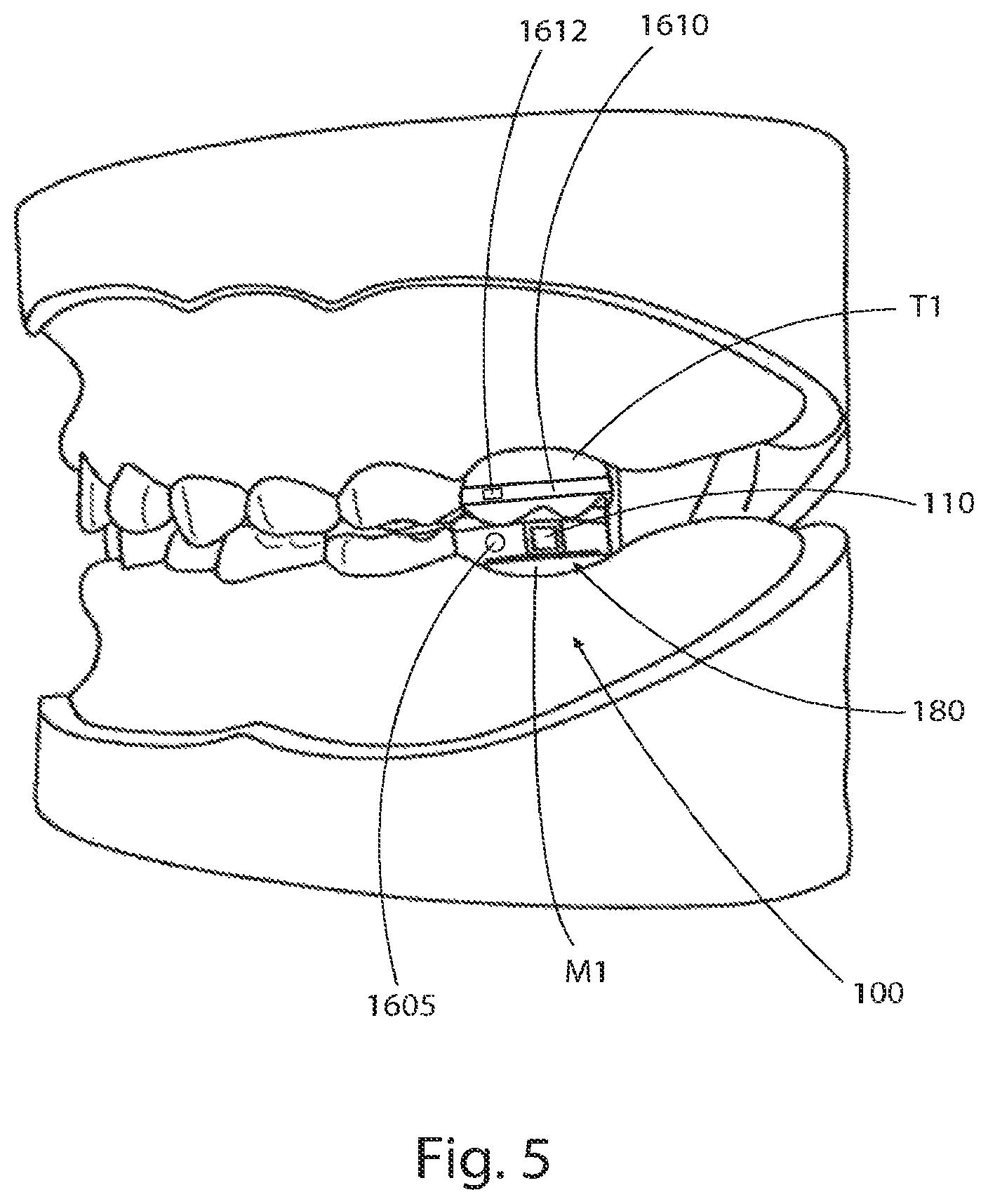 Patent US12310752 Figure 17 – Systems for measuring patient physiologic parameters