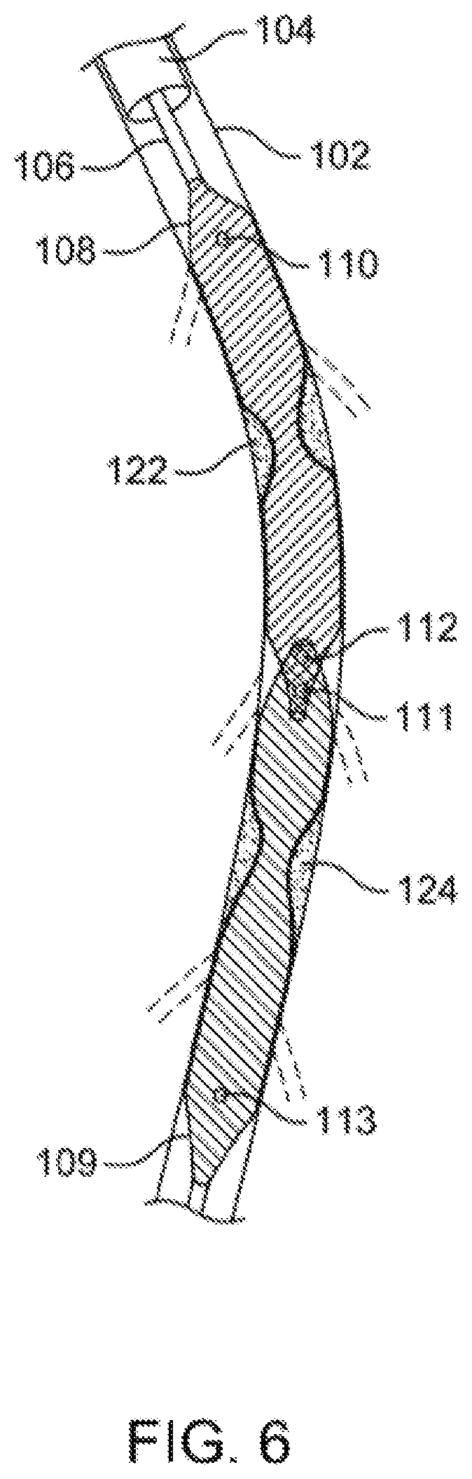 Patent US12310769 Figure 6 – Method for performing angiography and angioplasty within lumen of a blood vessel