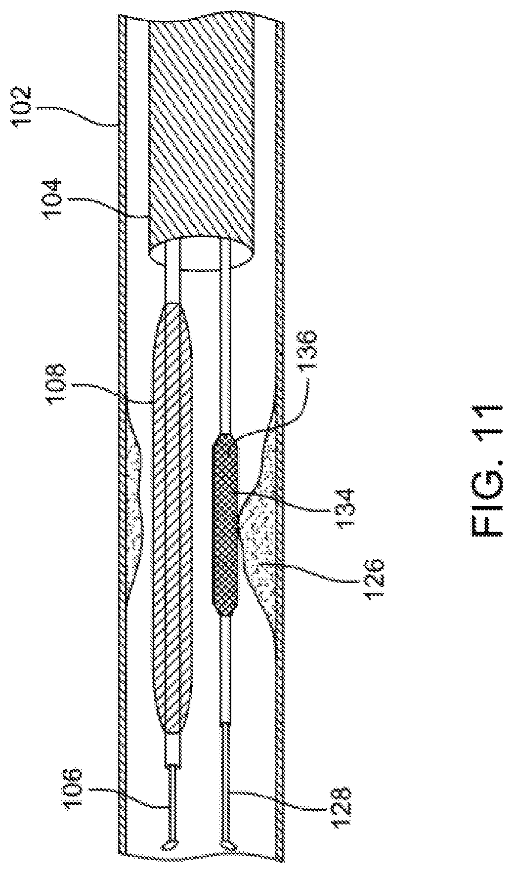 Patent US12310769 Figure 11 – Method for performing angiography and angioplasty within lumen of a blood vessel