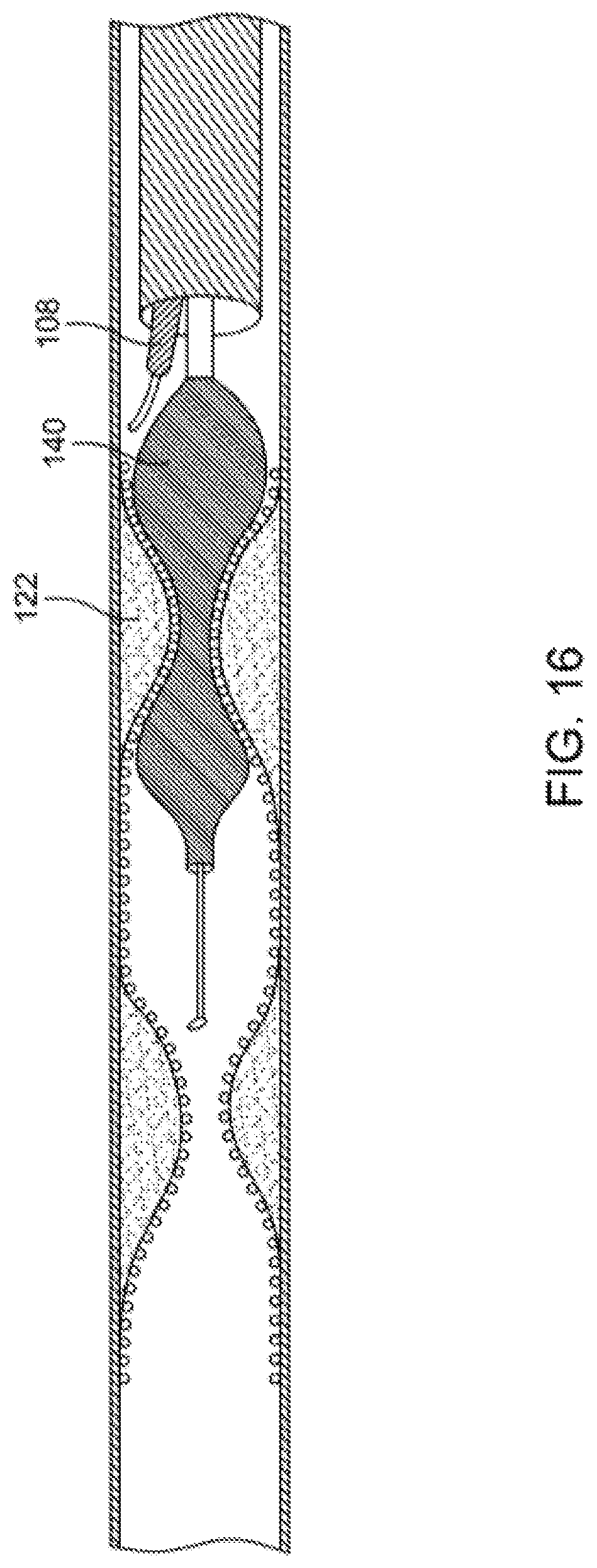 Patent US12310769 Figure 16 – Method for performing angiography and angioplasty within lumen of a blood vessel