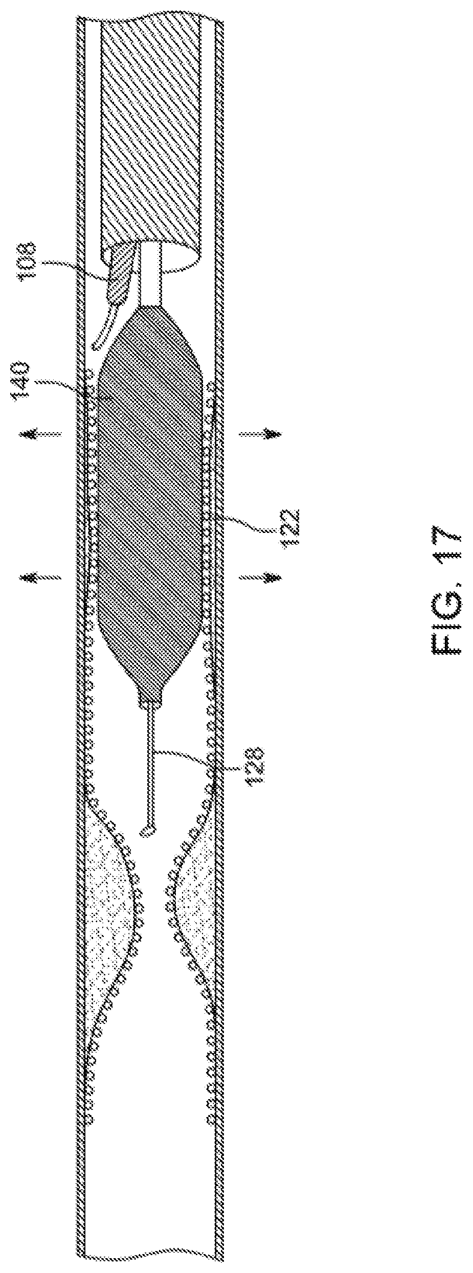 Patent US12310769 Figure 17 – Method for performing angiography and angioplasty within lumen of a blood vessel