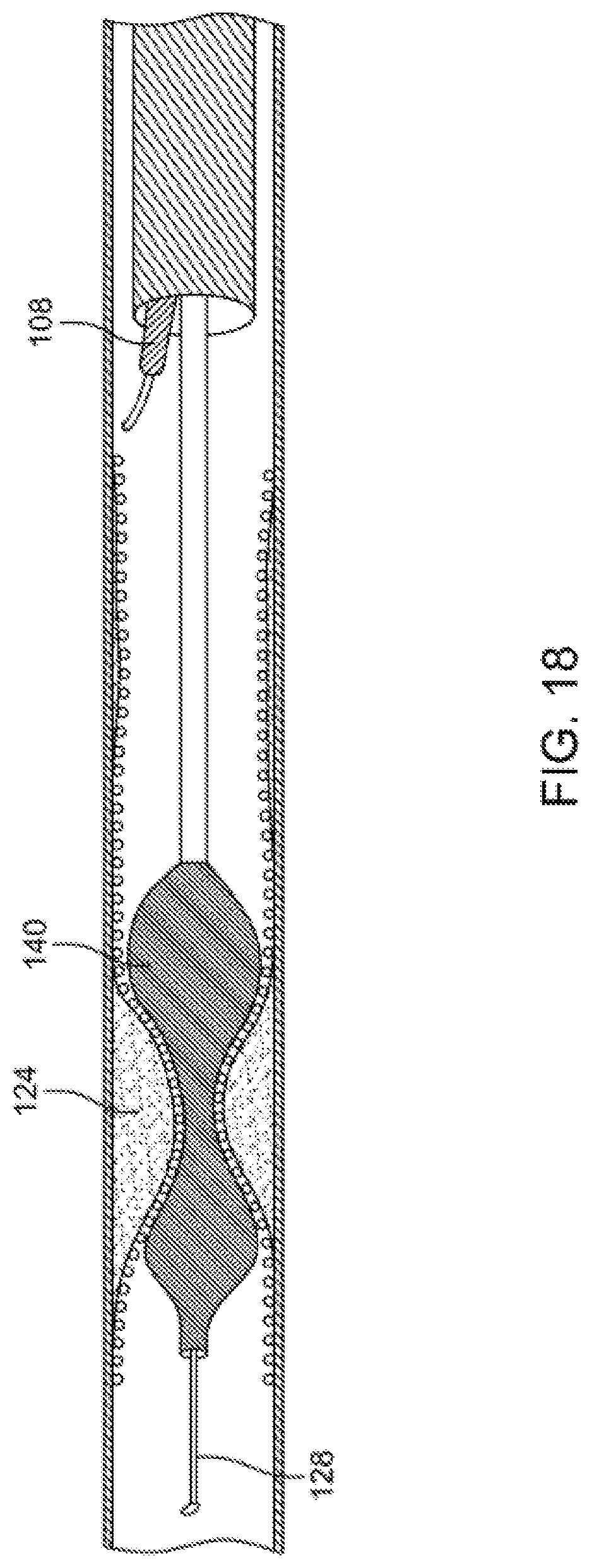 Patent US12310769 Figure 18 – Method for performing angiography and angioplasty within lumen of a blood vessel