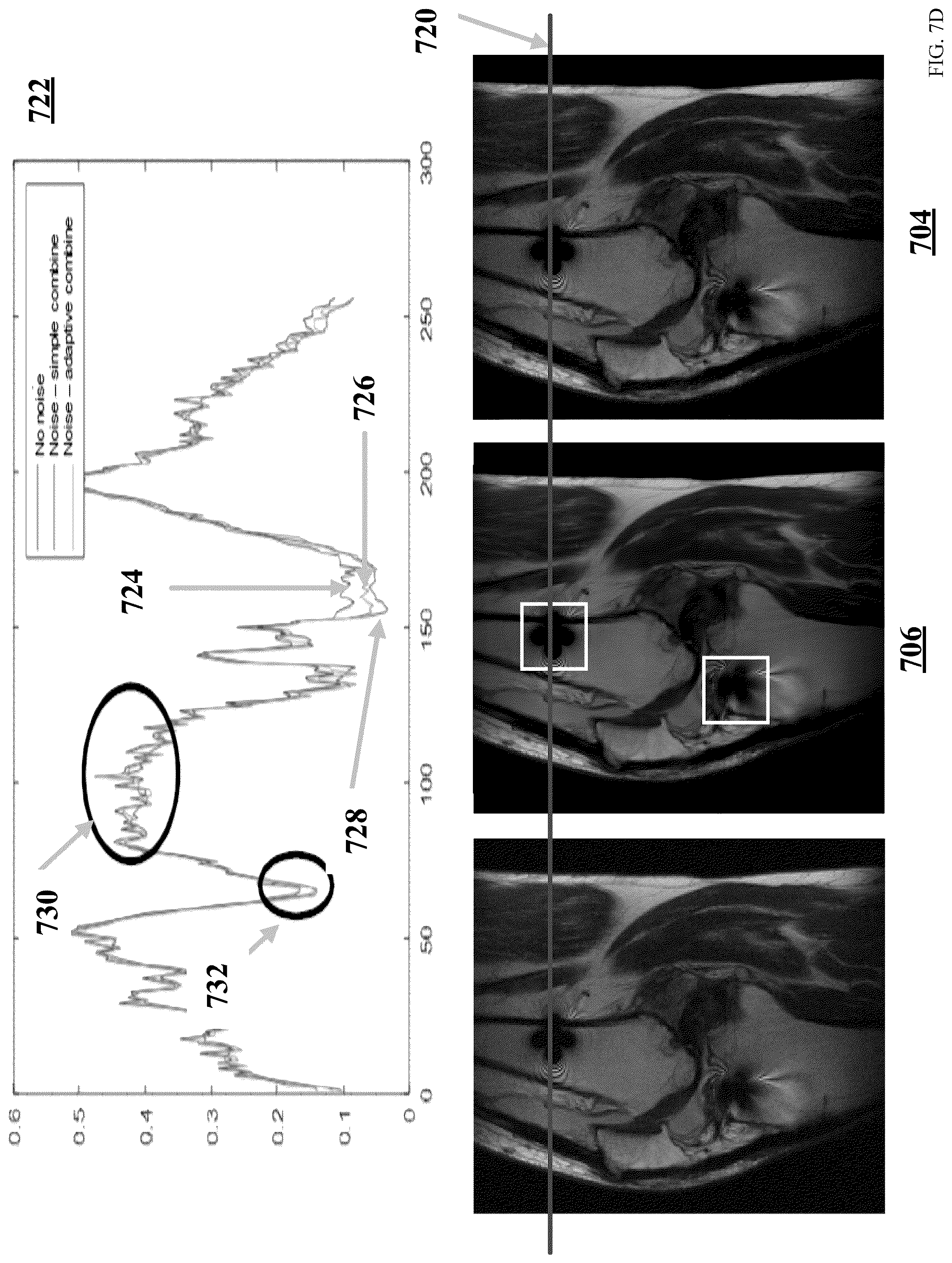 Patent US12310778 Figure 12 – Apparatus and methods for improved denoising in magnetic resonance imaging based on metal artifact reduction