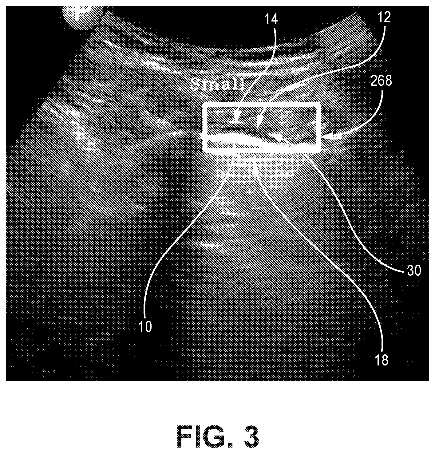 Patent US12310783 Figure 3 – Automated ultrasound video interpretation of a body part with one or more convolutional neural networks