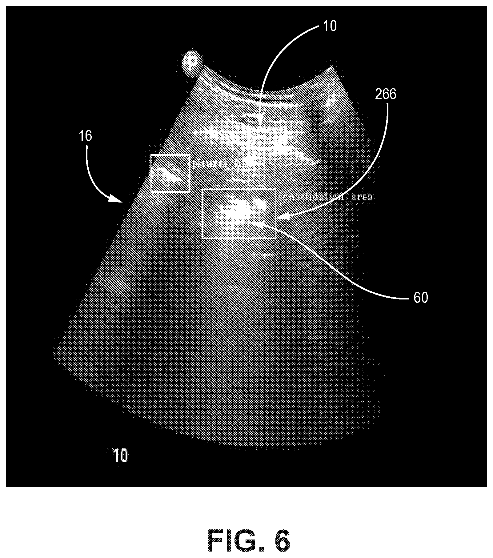 Patent US12310783 Figure 6 – Automated ultrasound video interpretation of a body part with one or more convolutional neural networks