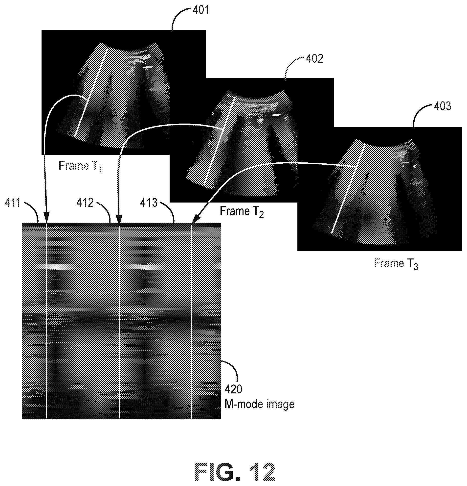 Patent US12310783 Figure 12 – Automated ultrasound video interpretation of a body part with one or more convolutional neural networks