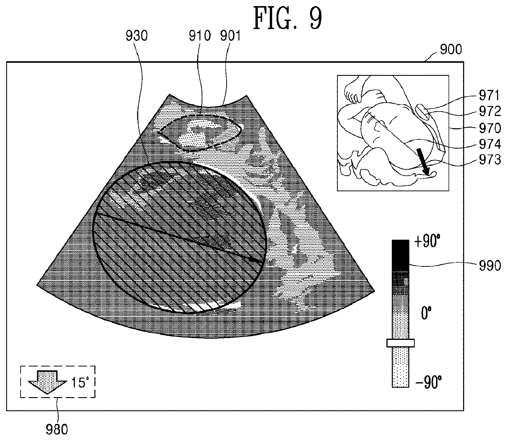 Patent US12310785 Figure 11 – Ultrasound imaging device and ultrasound image generation method for identifying degree of delivery progress of fetus